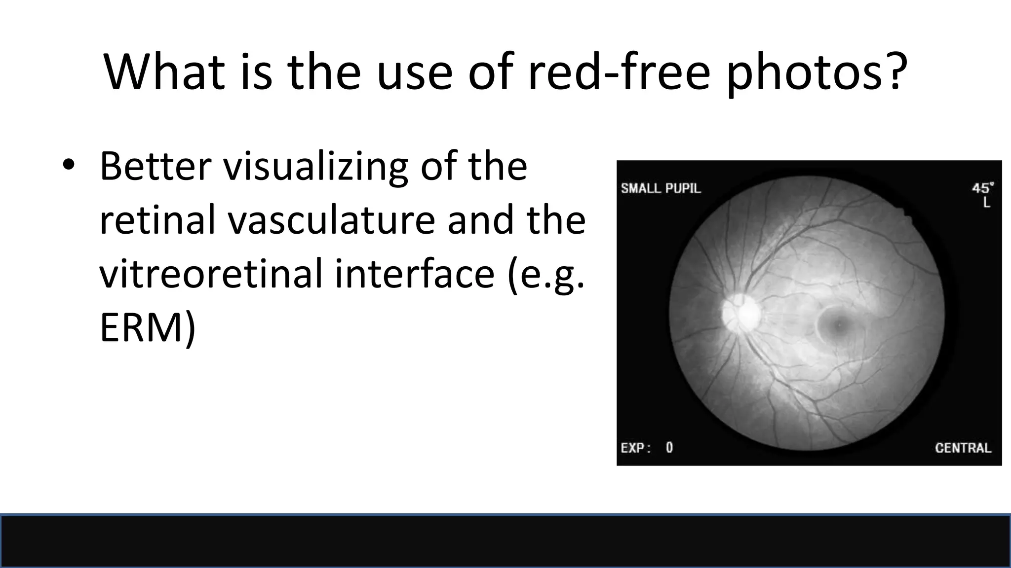 What is the use of red-free photos?
• Better visualizing of the
retinal vasculature and the
vitreoretinal interface (e.g.
ERM)
 