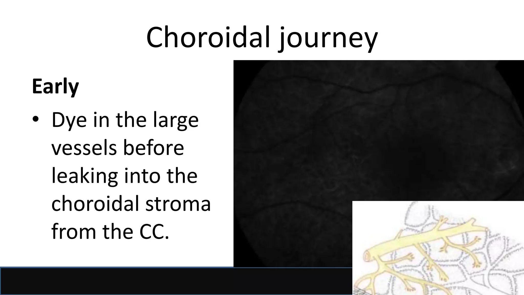 Choroidal journey
Early
• Dye in the large
vessels before
leaking into the
choroidal stroma
from the CC.
 