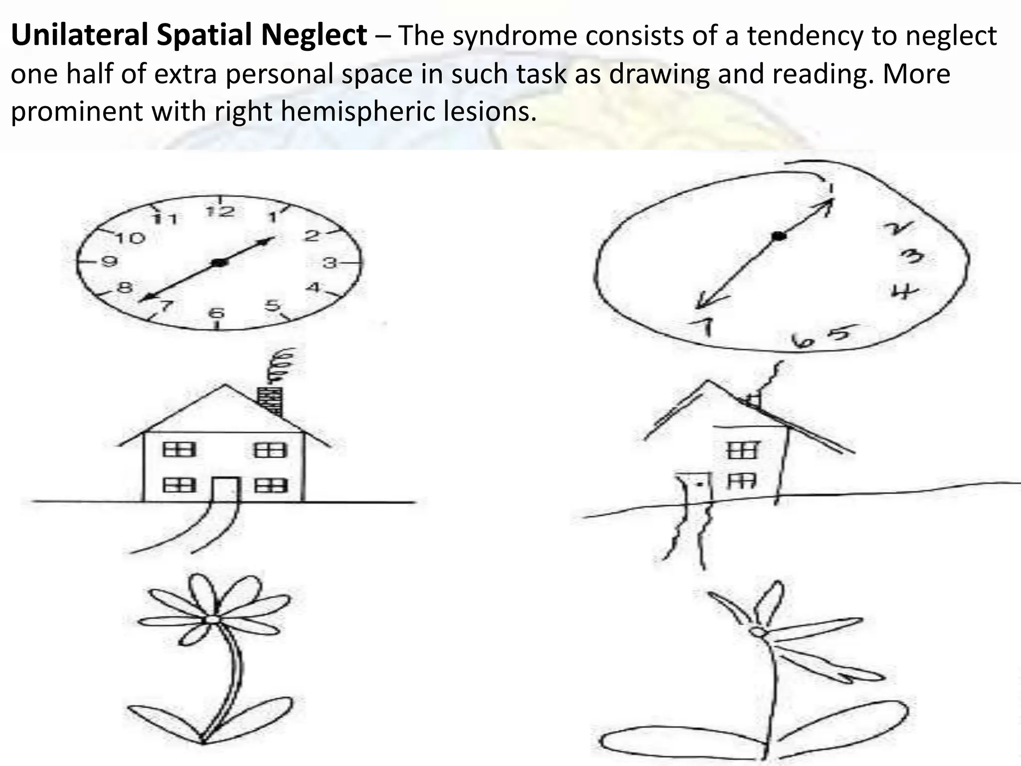 Unilateral Spatial Neglect – The syndrome consists of a tendency to neglect
one half of extra personal space in such task as drawing and reading. More
prominent with right hemispheric lesions.
 