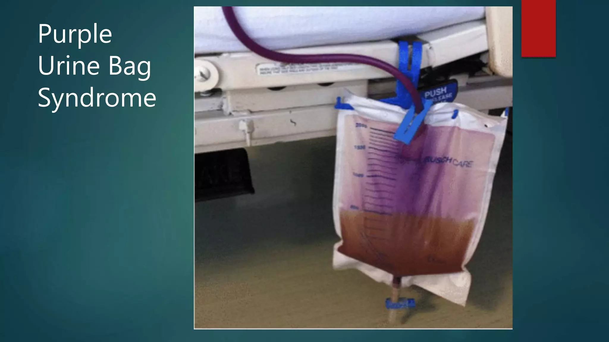 Purple
Urine Bag
Syndrome
 