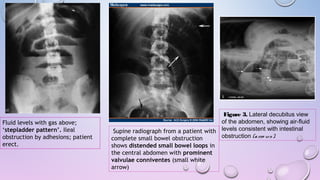 Fluid levels with gas above;
‘stepladder pattern’. Ileal
obstruction by adhesions; patient
erect.
 Supine radiograph from a patient with
complete small bowel obstruction
shows distended small bowel loops in
the central abdomen with prominent
valvulae conniventes (small white
arrow)
 Figure 3. Lateral decubitus view
of the abdomen, showing air-fluid
levels consistent with intestinal
obstruction (arro ws).
 