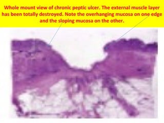 Whole mount view of chronic peptic ulcer. The external muscle layer
has been totally destroyed. Note the overhanging mucosa on one edge
and the sloping mucosa on the other.

 