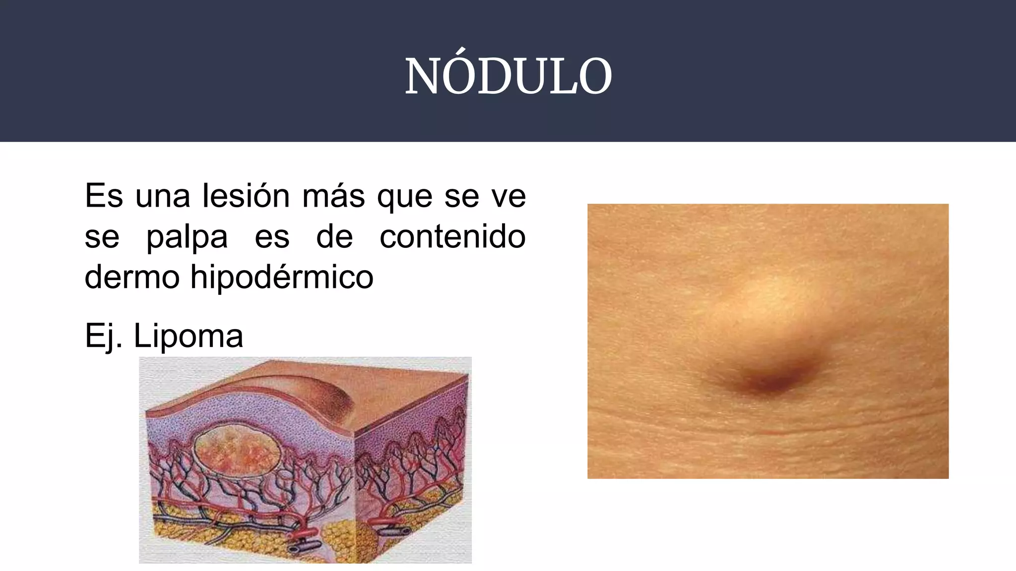 NÓDULO
Es una lesión más que se ve
se palpa es de contenido
dermo hipodérmico
Ej. Lipoma
 