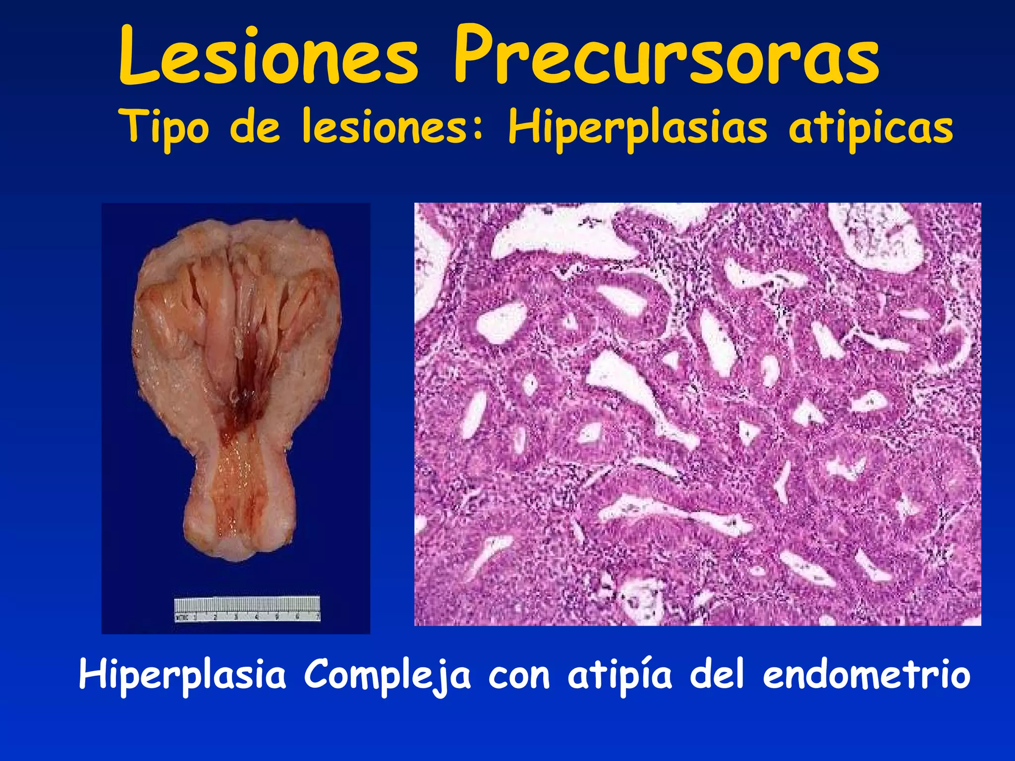 Hiperplasia Compleja con atipía del endometrio Lesiones Precursoras Tipo de lesiones: Hiperplasias atipicas 