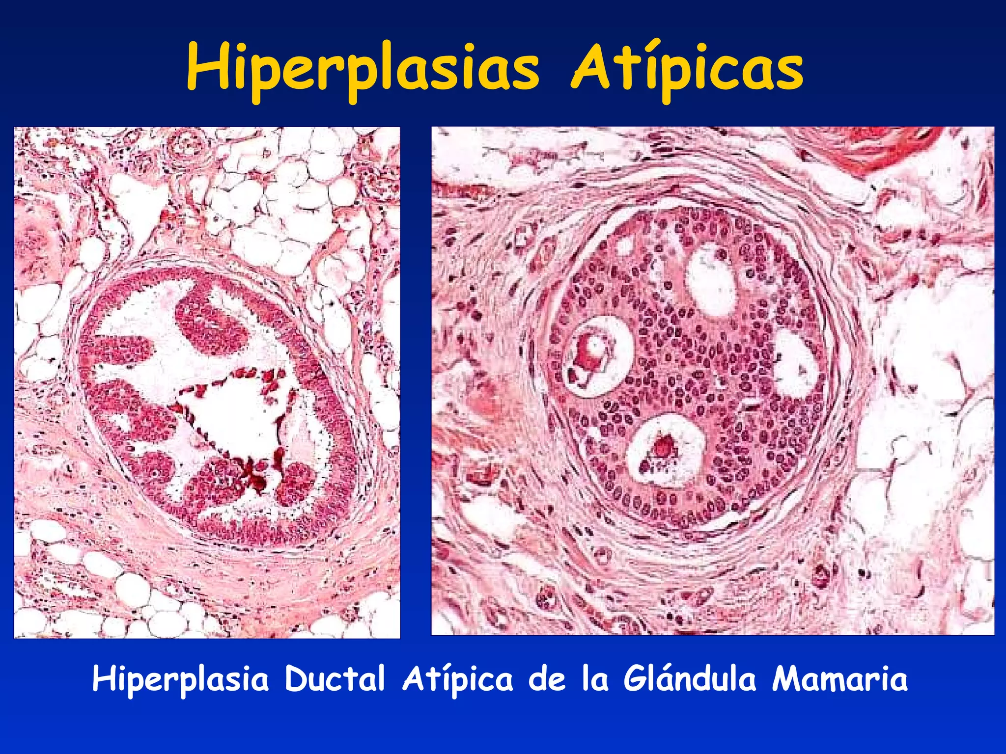Hiperplasias Atípicas Hiperplasia Ductal Atípica de la Glándula Mamaria 