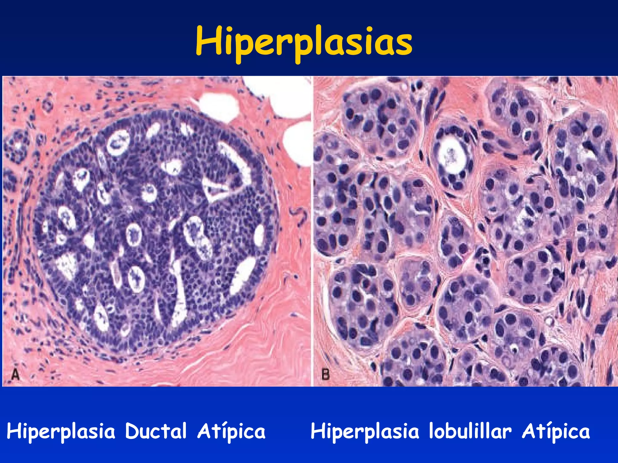 Hiperplasias Hiperplasia Ductal Atípica Hiperplasia lobulillar Atípica 