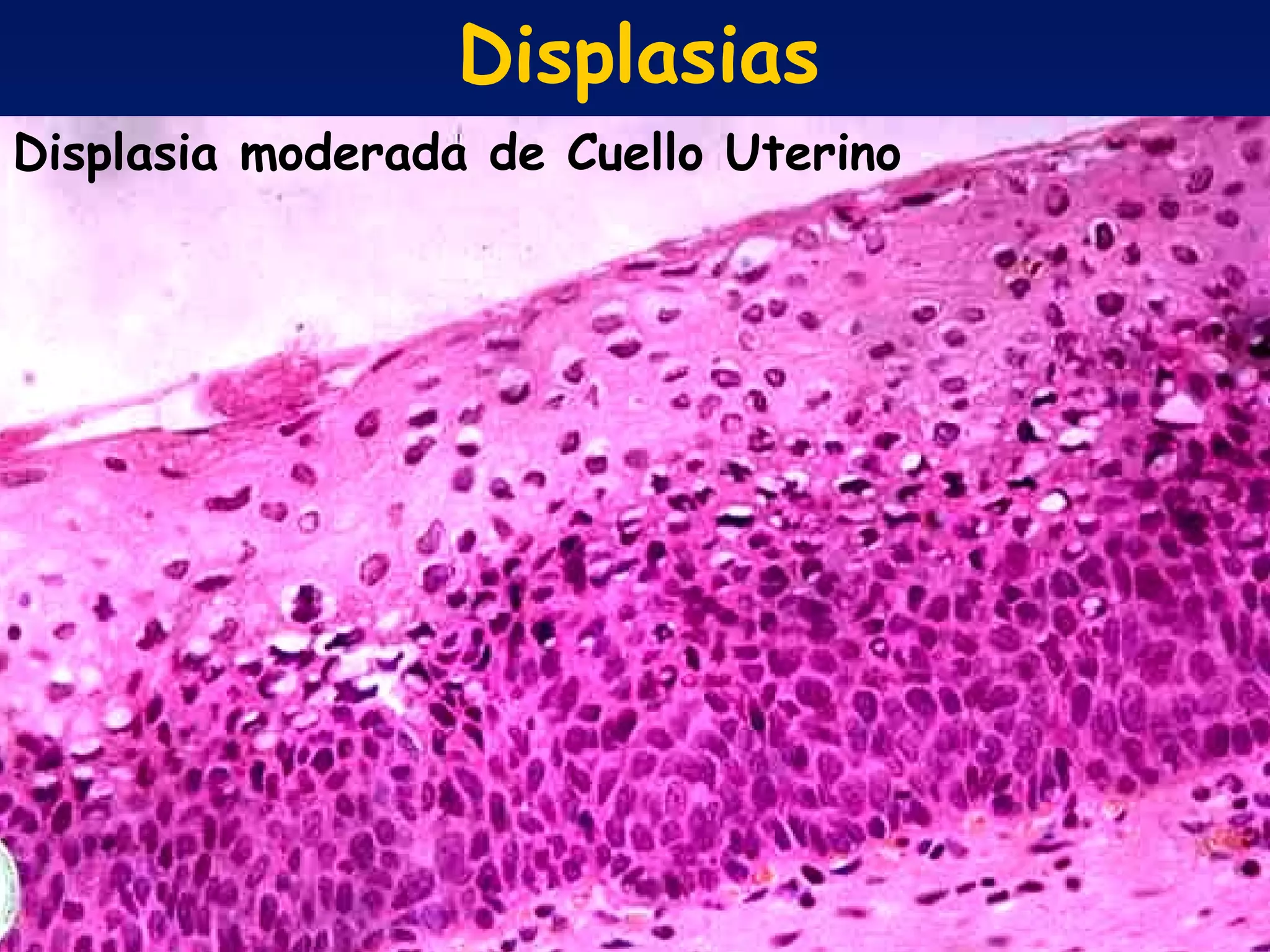 Displasia moderada de Cuello Uterino Displasias 