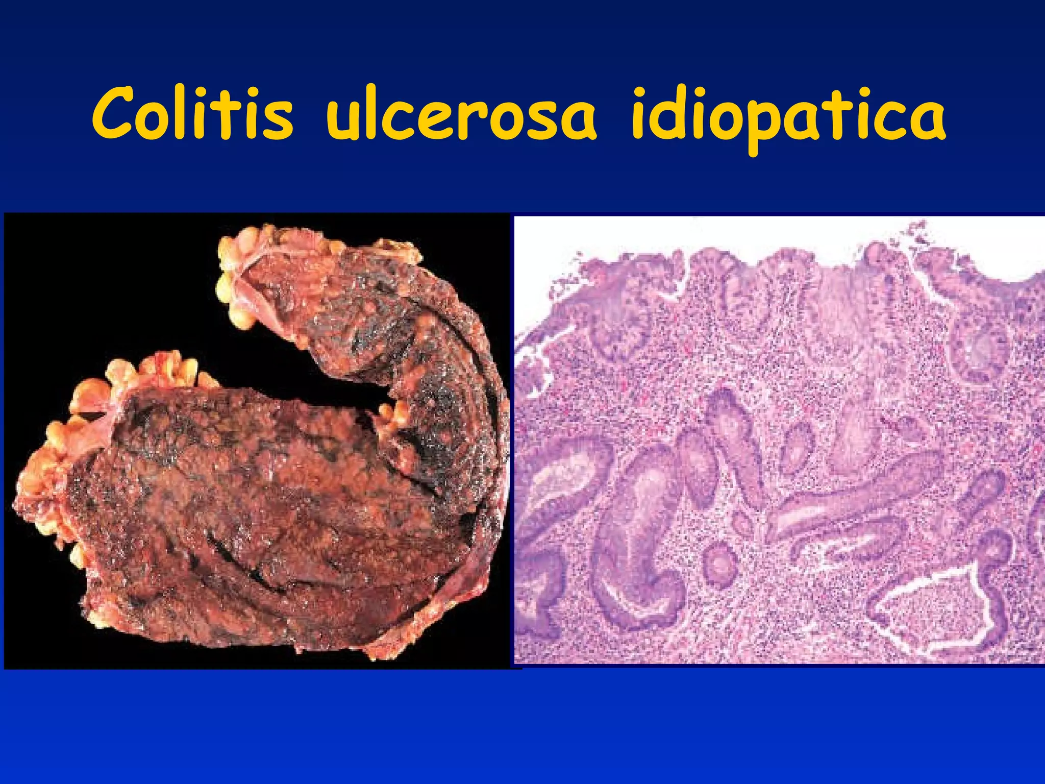 Colitis ulcerosa idiopatica 