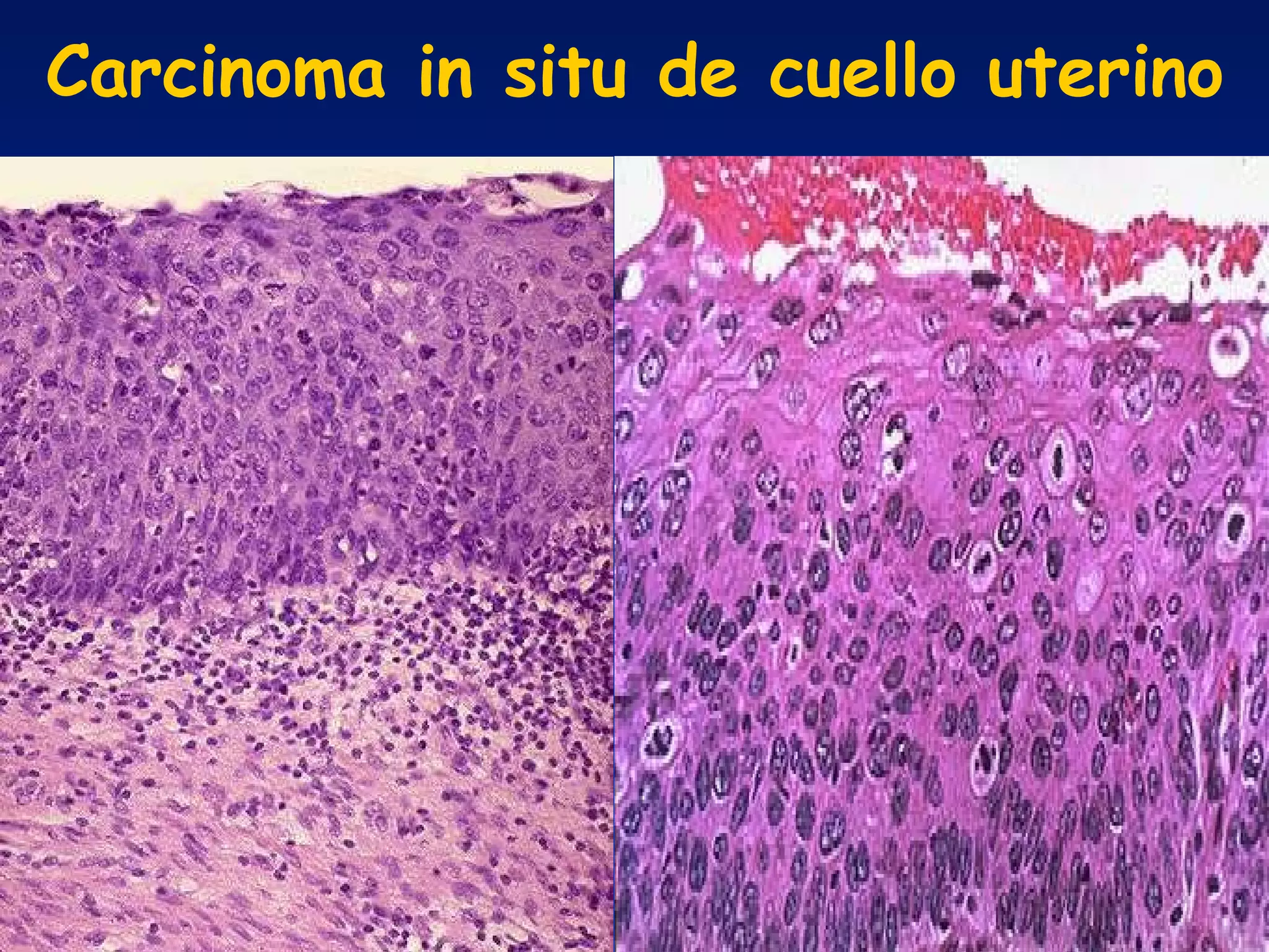 Carcinoma in situ de cuello uterino 