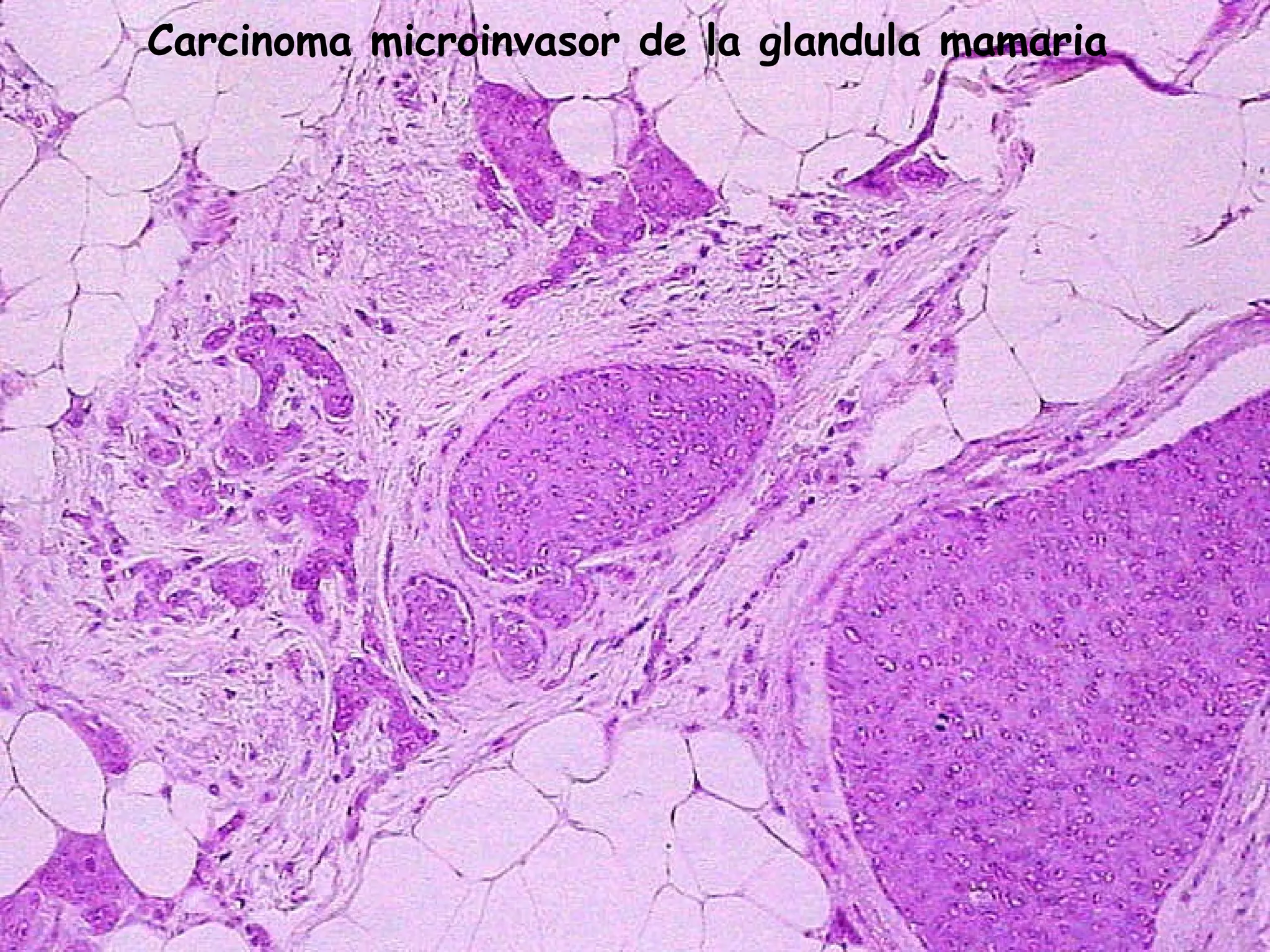 Carcinoma microinvasor de la glandula mamaria 