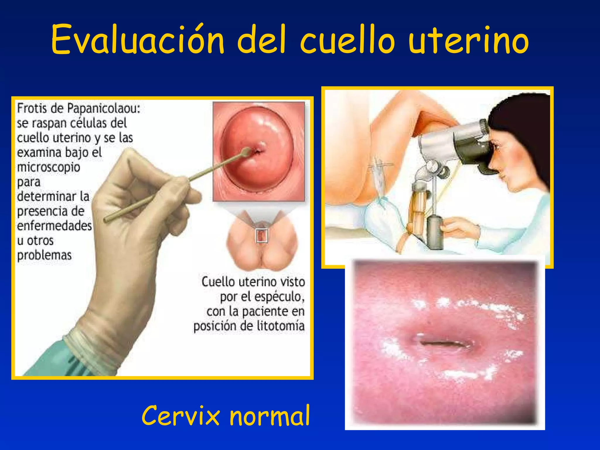Evaluación del cuello uterino Cervix normal 