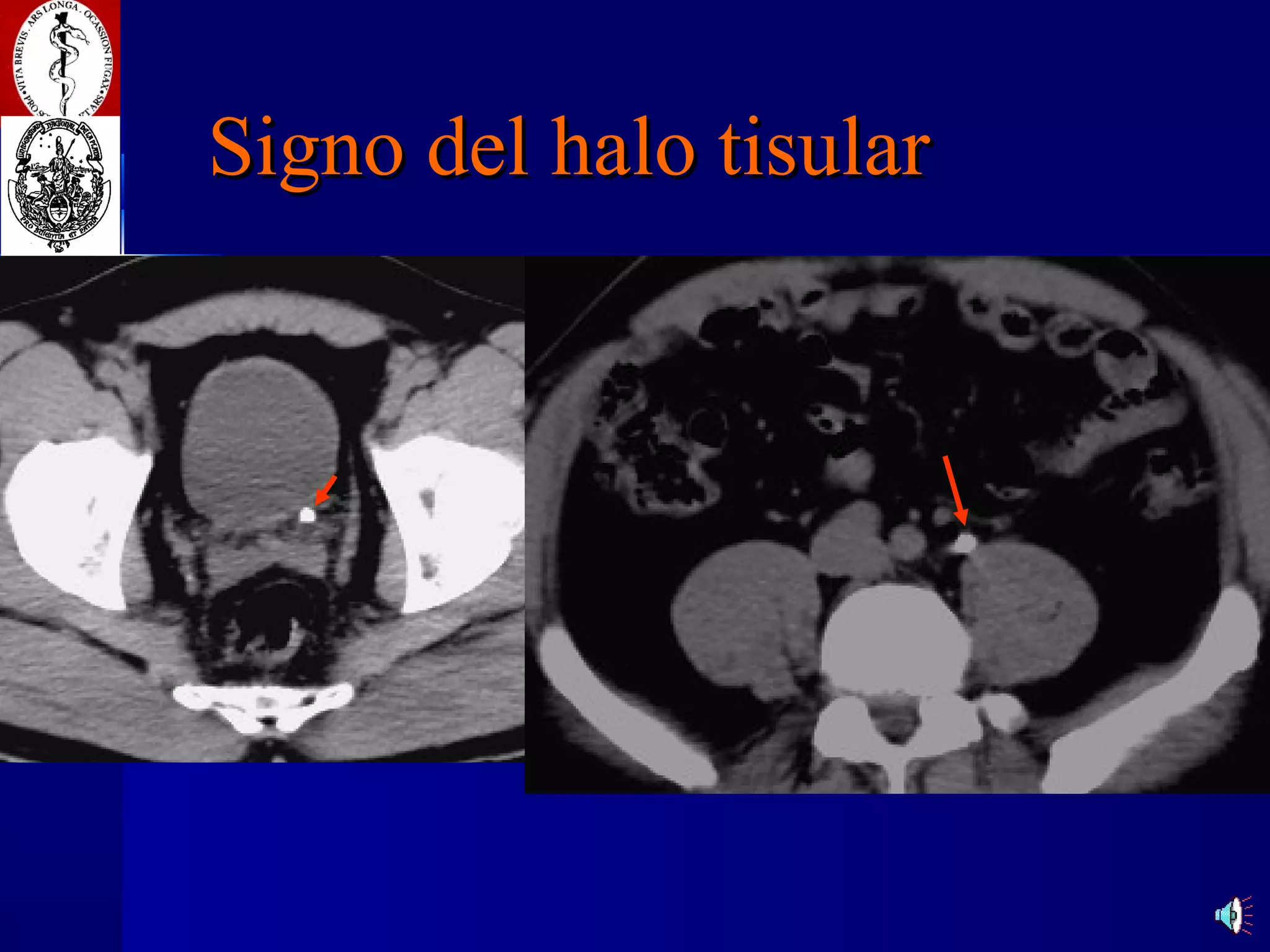 Signo del halo tisular 