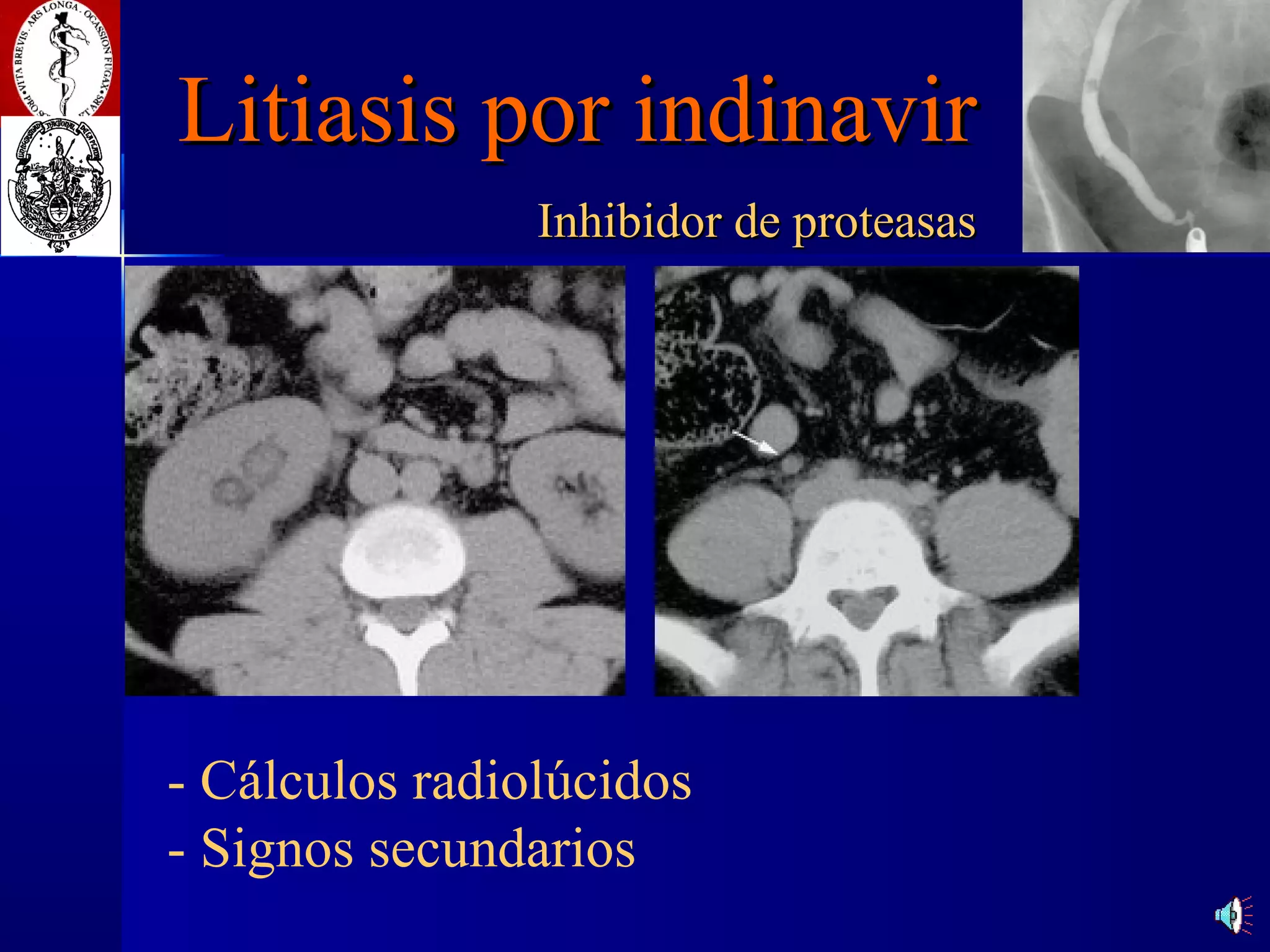 Litiasis por indinavir   Inhibidor de proteasas - Cálculos radiol ú cidos - Signos secundarios 