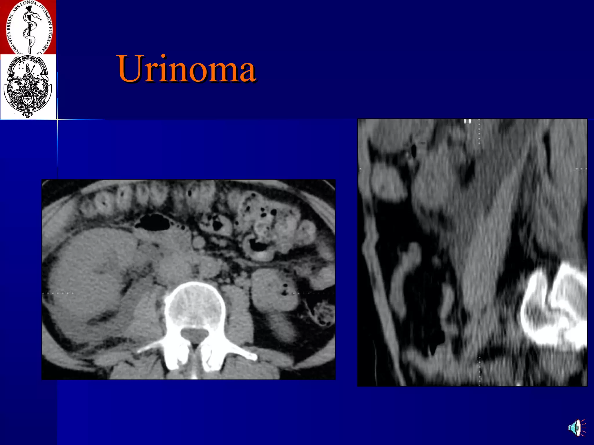 Urinoma 