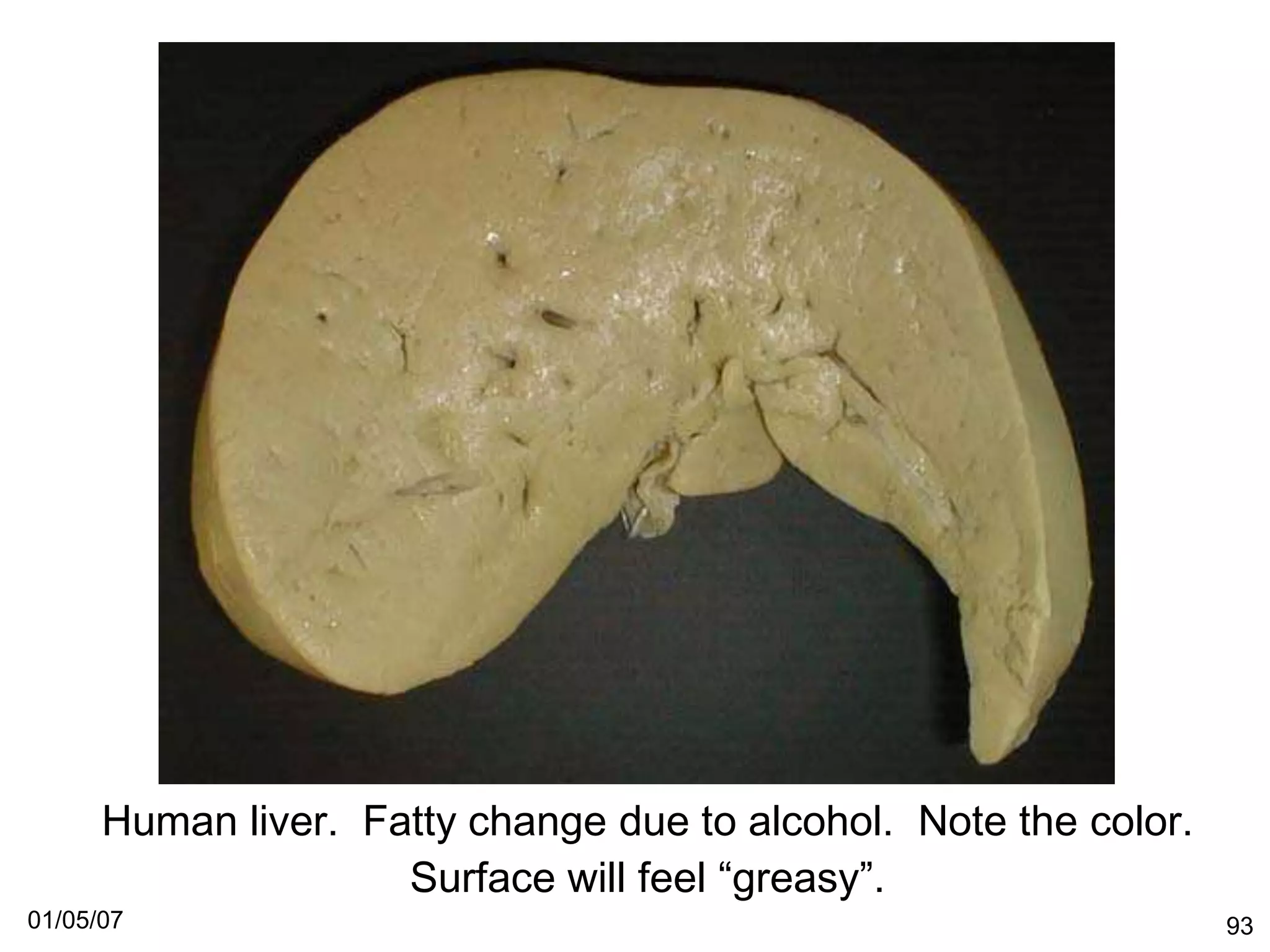 Human liver. Fatty change due to alcohol. Note the color.
                     Surface will feel “greasy”.
01/05/07                                                          93
 