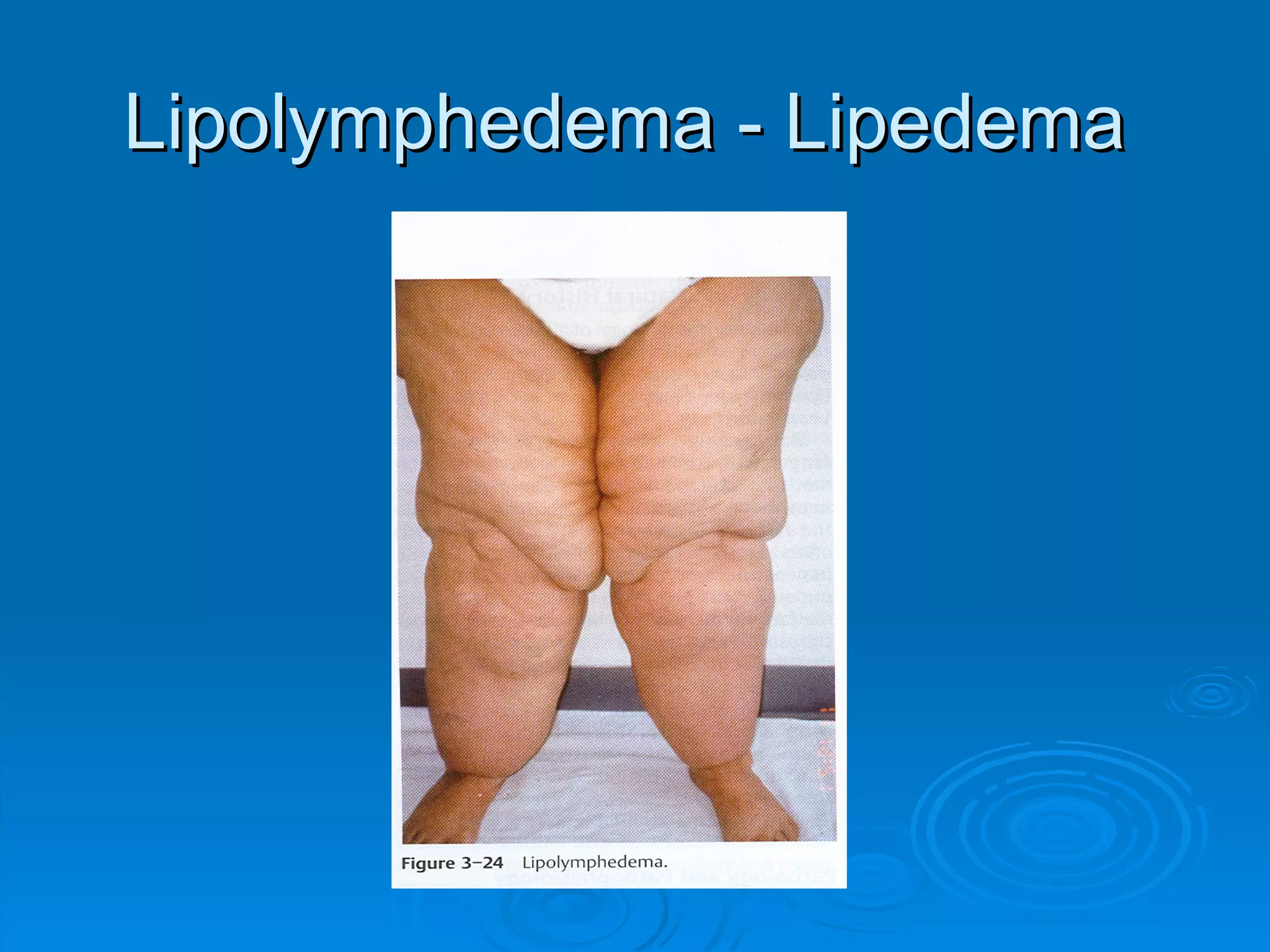 Lipolymphedema - Lipedema 