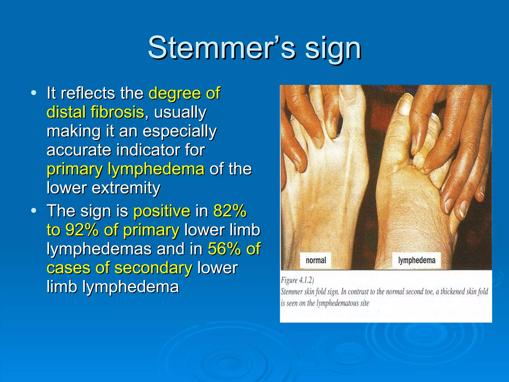 Stemmer’s sign It reflects the  degree of distal fibrosis , usually making it an especially accurate indicator for  primary lymphedema  of the lower extremity The sign is  positive  in  82% to 92% of primary  lower limb lymphedemas and in  56% of cases of secondary  lower limb lymphedema 