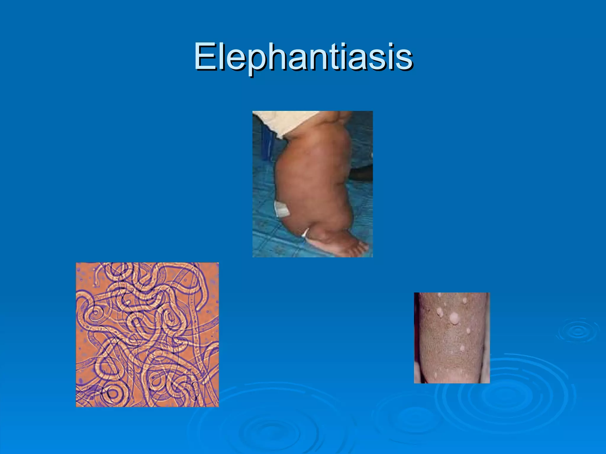 Elephantiasis 