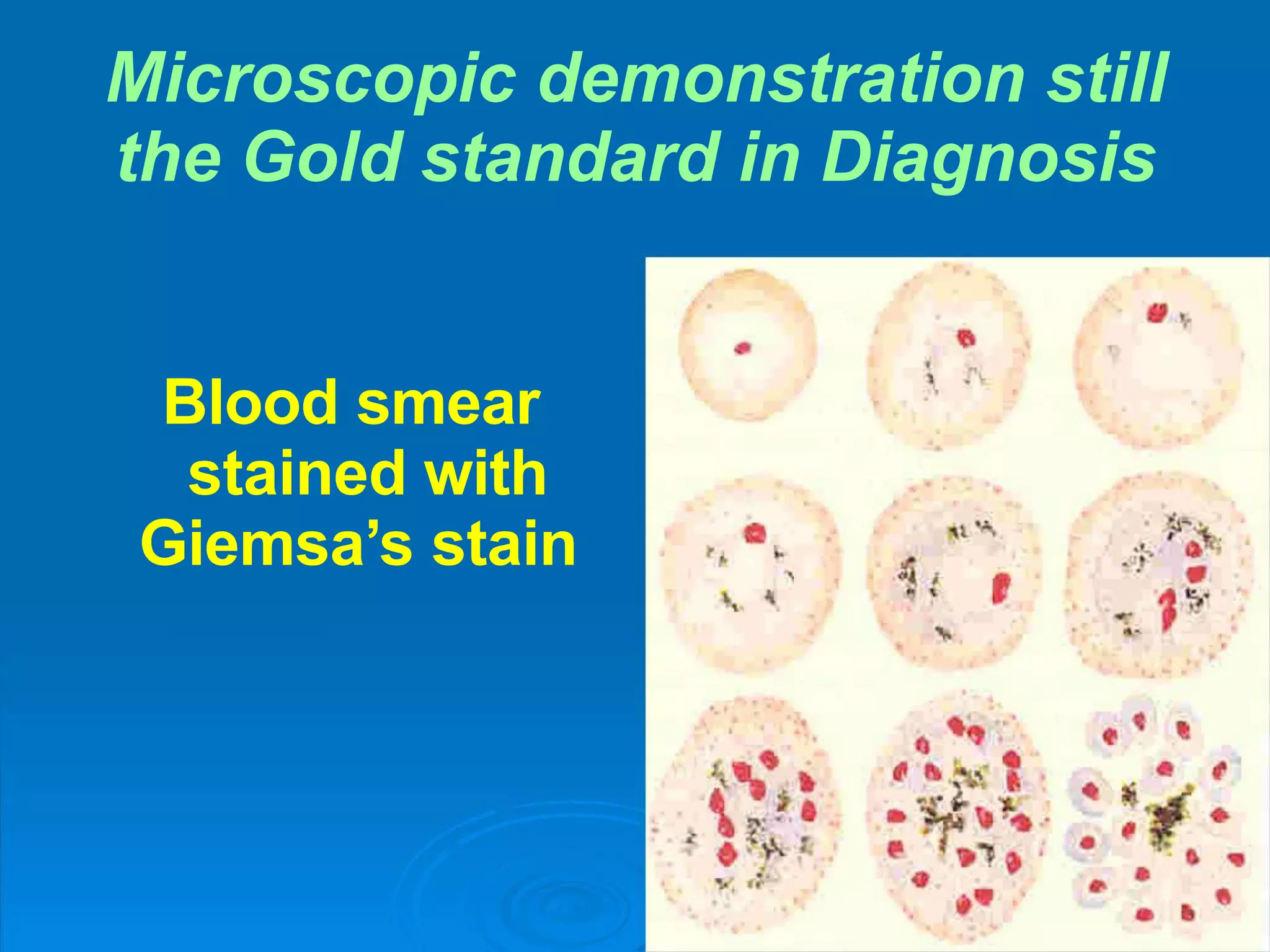 Microscopic demonstration still
the Gold standard in Diagnosis
Blood smear
stained with
Giemsa’s stain
 