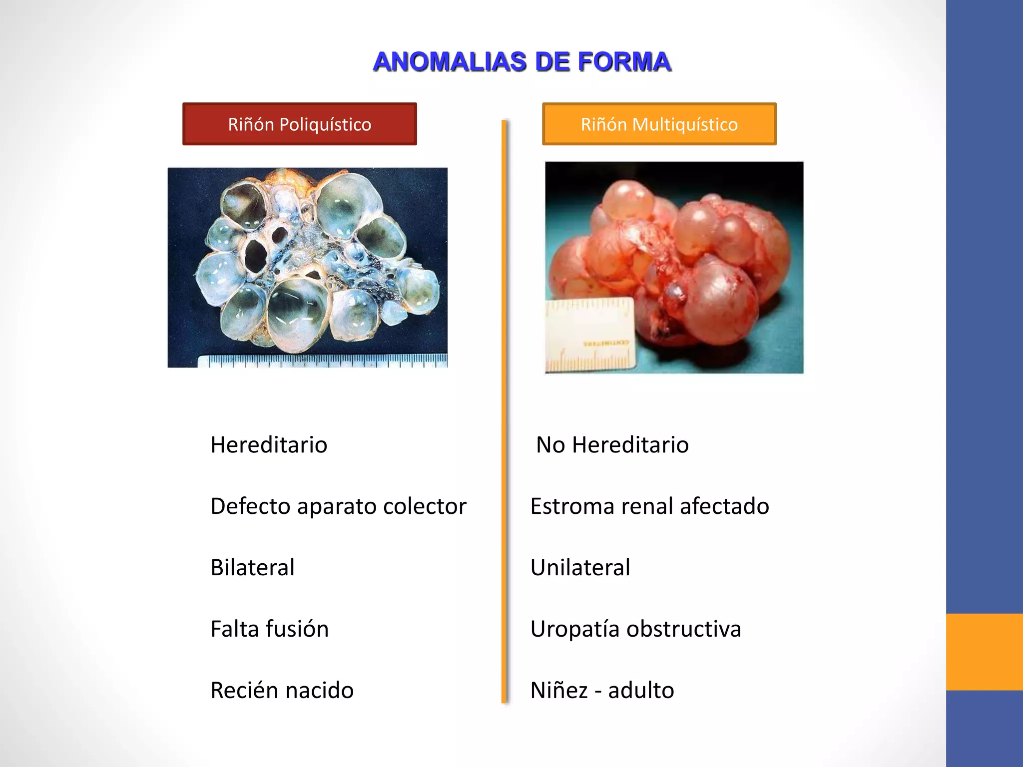 ANOMALIAS DE FORMA
Riñón Poliquístico Riñón Multiquístico
Hereditario
Defecto aparato colector
Bilateral
Falta fusión
Recién nacido
No Hereditario
Estroma renal afectado
Unilateral
Uropatía obstructiva
Niñez - adulto
 