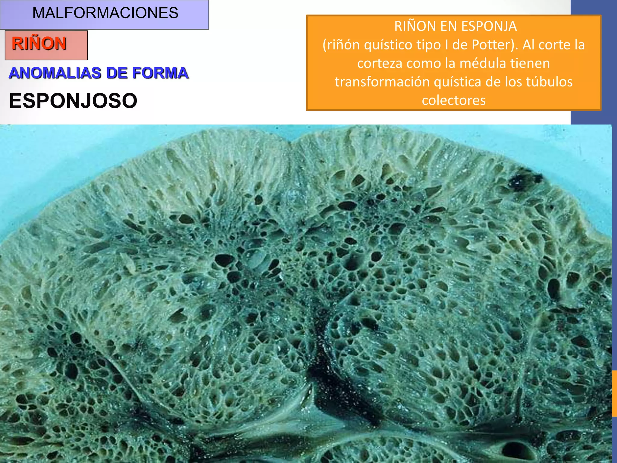 MALFORMACIONES
RIÑON
ANOMALIAS DE FORMA
ESPONJOSO
RIÑON EN ESPONJA
(riñón quístico tipo I de Potter). Al corte la
corteza como la médula tienen
transformación quística de los túbulos
colectores
 