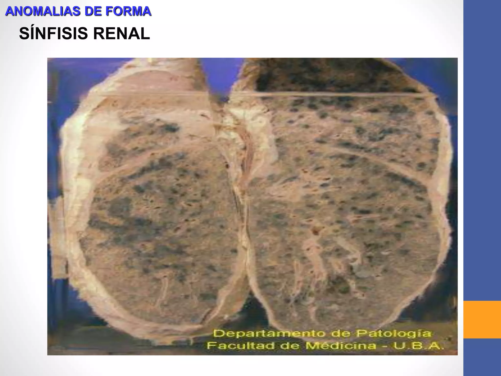SÍNFISIS RENAL
ANOMALIAS DE FORMA
 