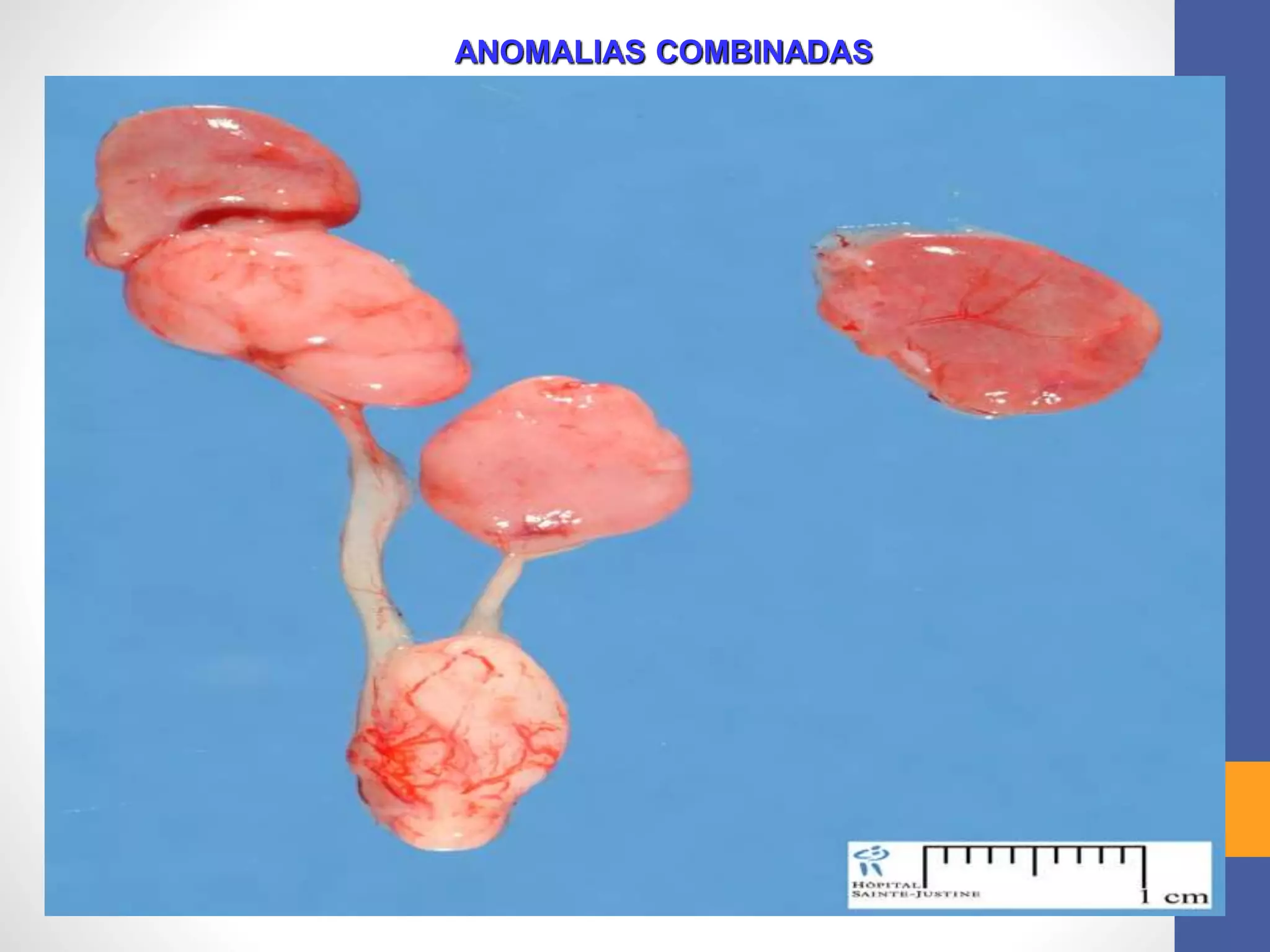 ANOMALIAS COMBINADAS
 