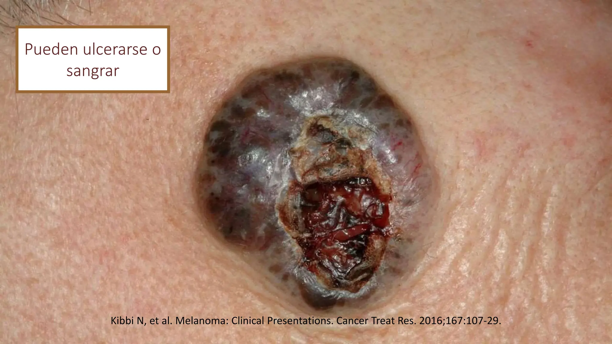 Pueden ulcerarse o
sangrar
Kibbi N, et al. Melanoma: Clinical Presentations. Cancer Treat Res. 2016;167:107-29.
 