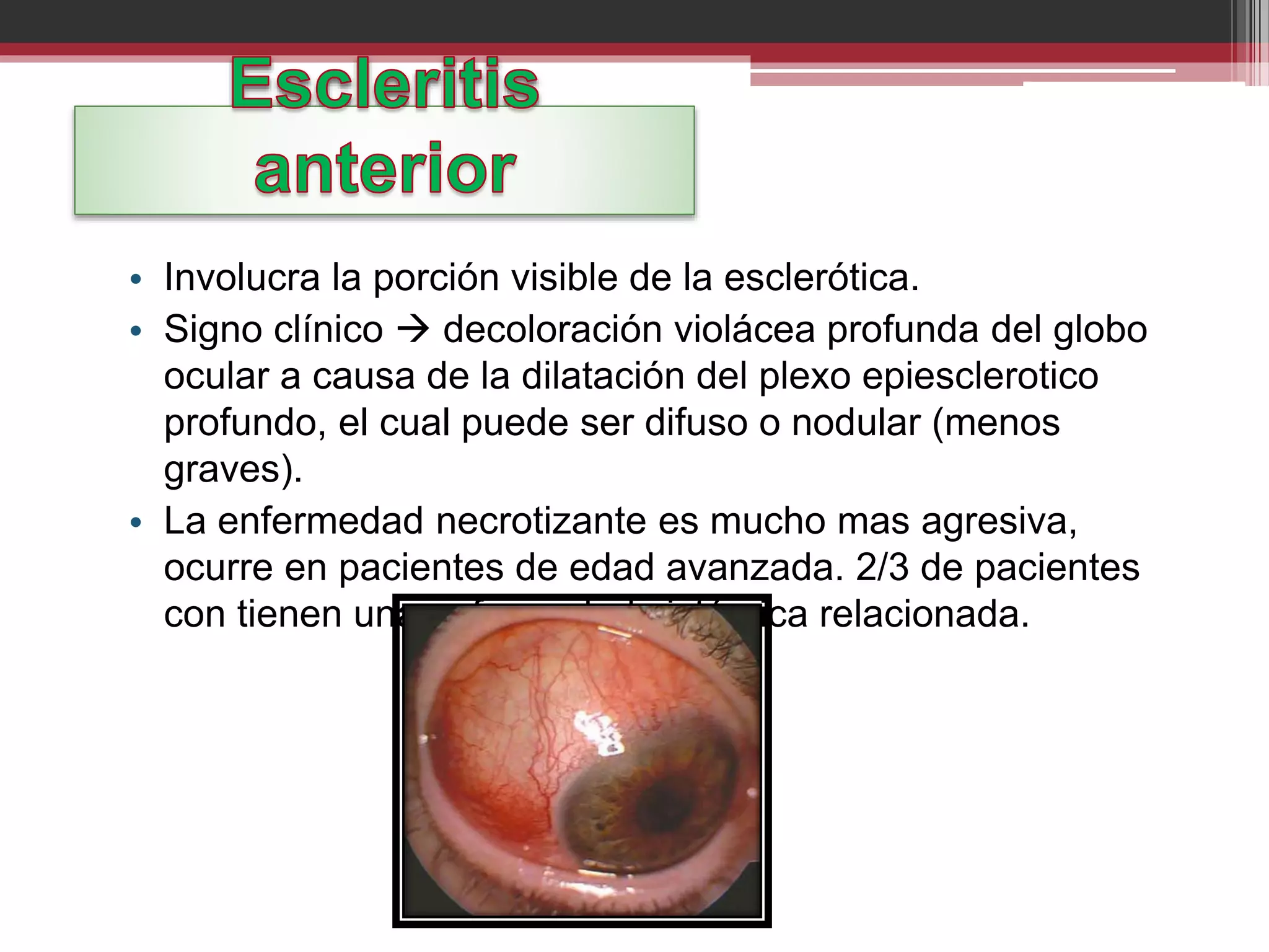 • Involucra la porción visible de la esclerótica.
• Signo clínico  decoloración violácea profunda del globo
ocular a causa de la dilatación del plexo epiesclerotico
profundo, el cual puede ser difuso o nodular (menos
graves).
• La enfermedad necrotizante es mucho mas agresiva,
ocurre en pacientes de edad avanzada. 2/3 de pacientes
con tienen una enfermedad sistémica relacionada.
 