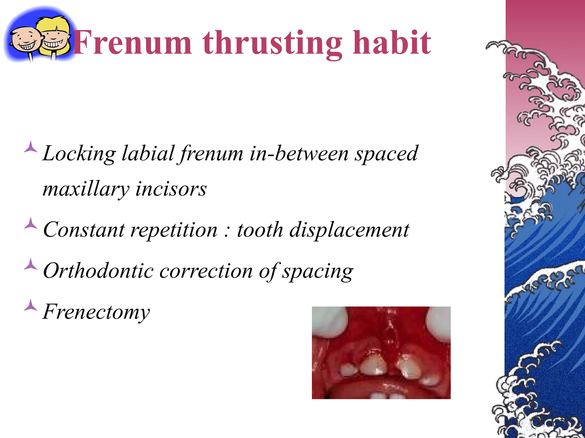 Frenum thrusting habit
Locking labial frenum in-between spaced
maxillary incisors
Constant repetition : tooth displacement
Orthodontic correction of spacing
Frenectomy
 
