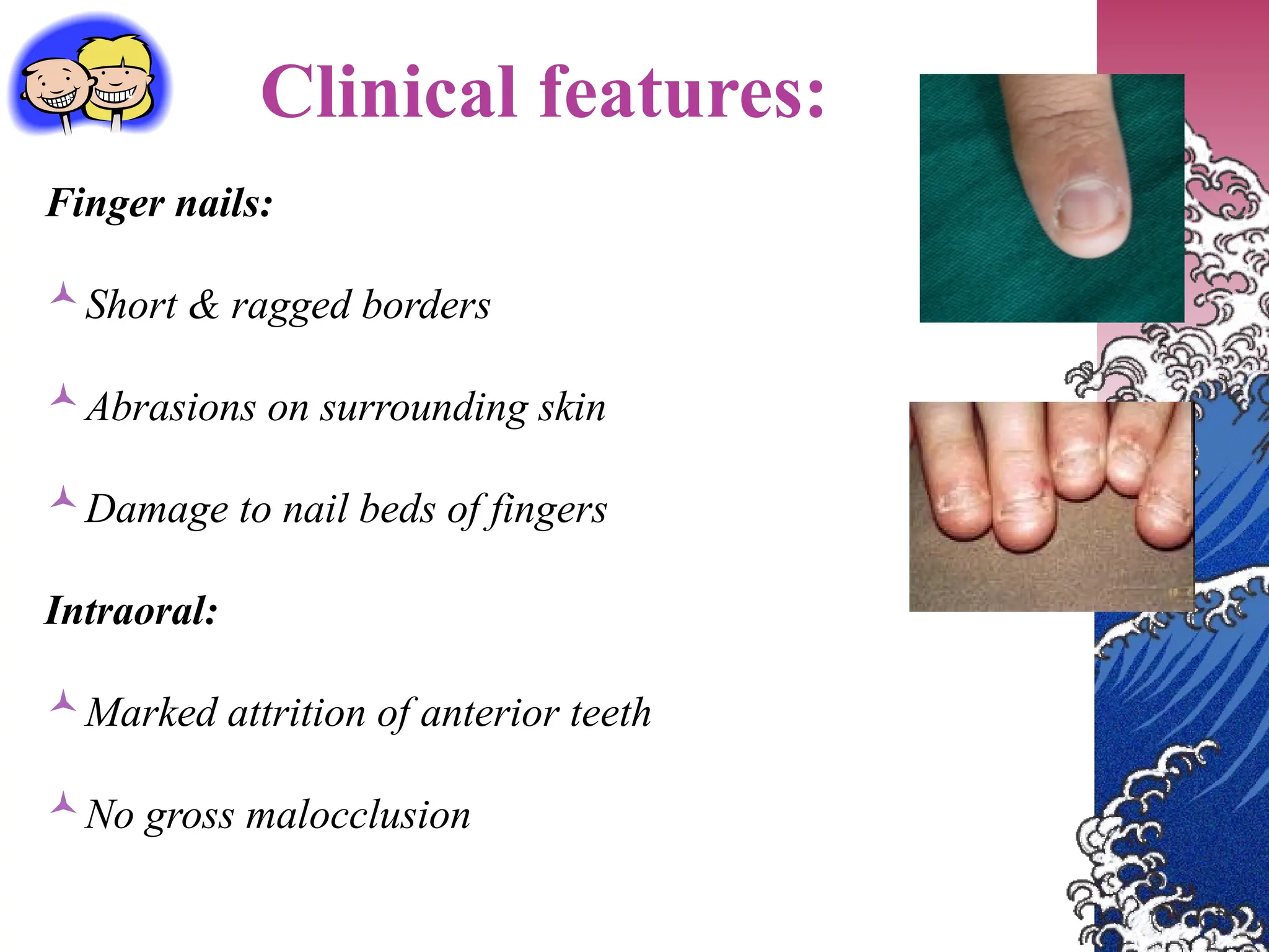 Clinical features:
Finger nails:
Short & ragged borders
Abrasions on surrounding skin
Damage to nail beds of fingers
Intraoral:
Marked attrition of anterior teeth
No gross malocclusion
 