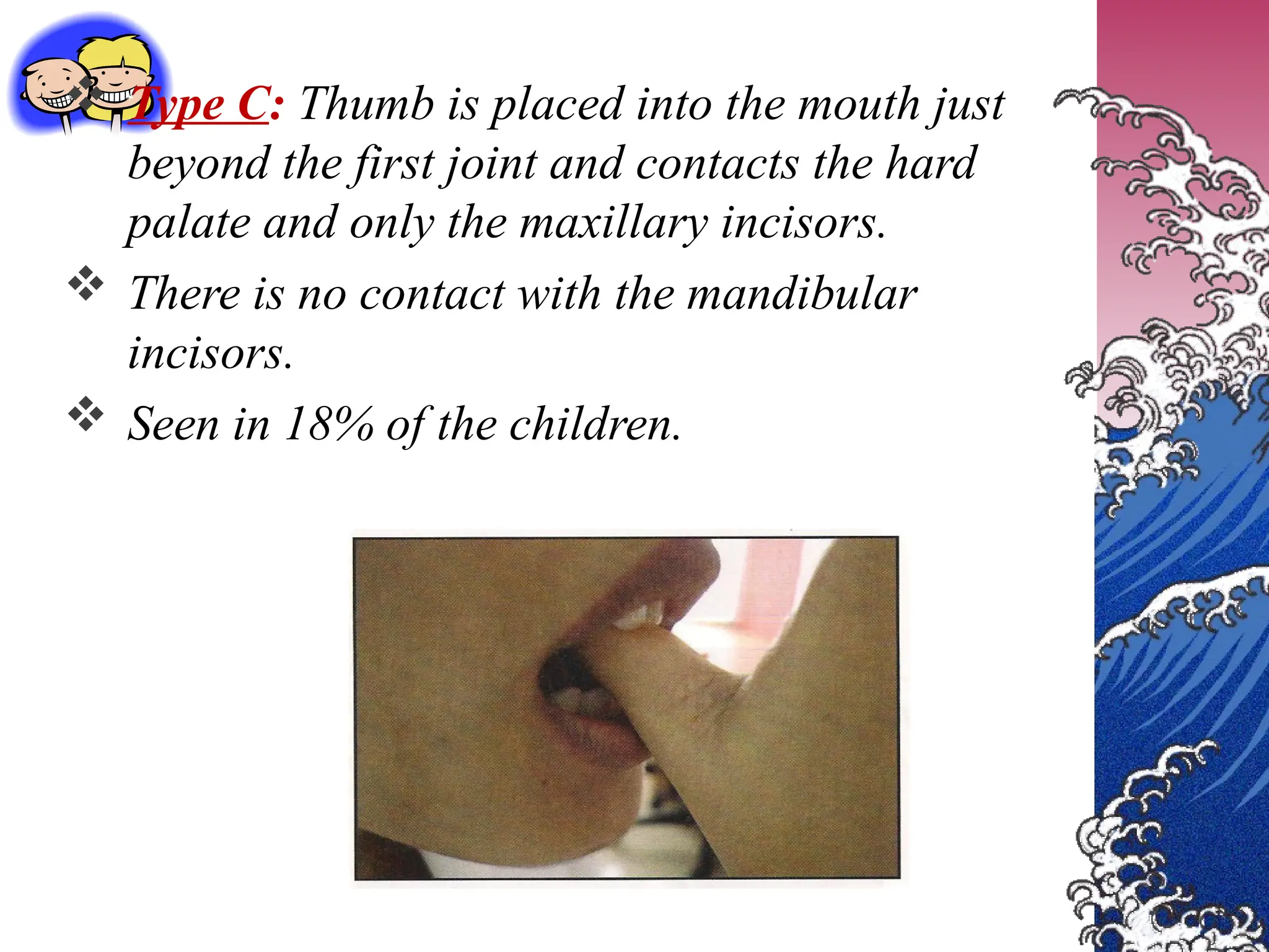  Type C: Thumb is placed into the mouth just
beyond the first joint and contacts the hard
palate and only the maxillary incisors.
 There is no contact with the mandibular
incisors.
 Seen in 18% of the children.
 