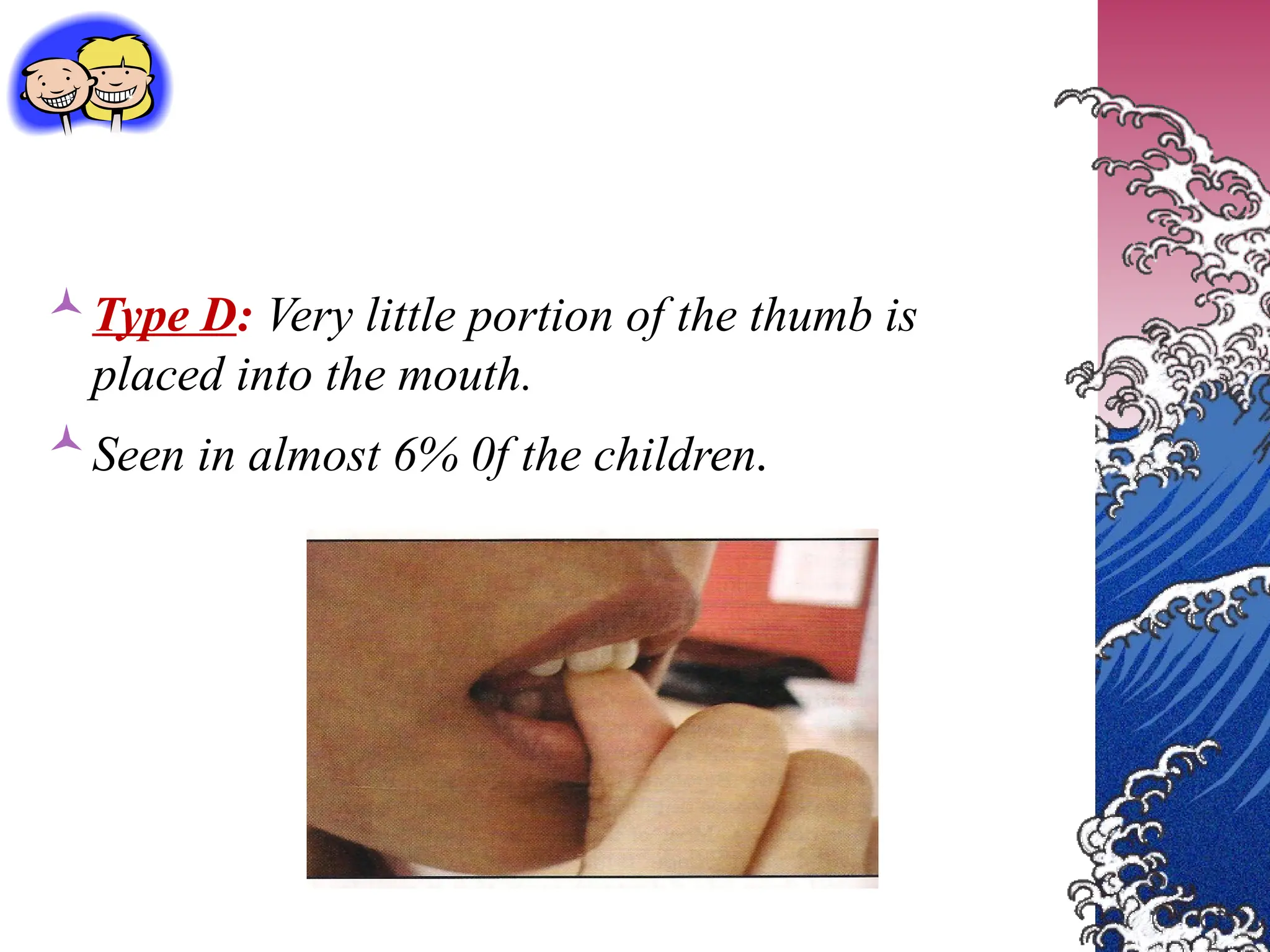 Type D: Very little portion of the thumb is
placed into the mouth.
Seen in almost 6% 0f the children.
 