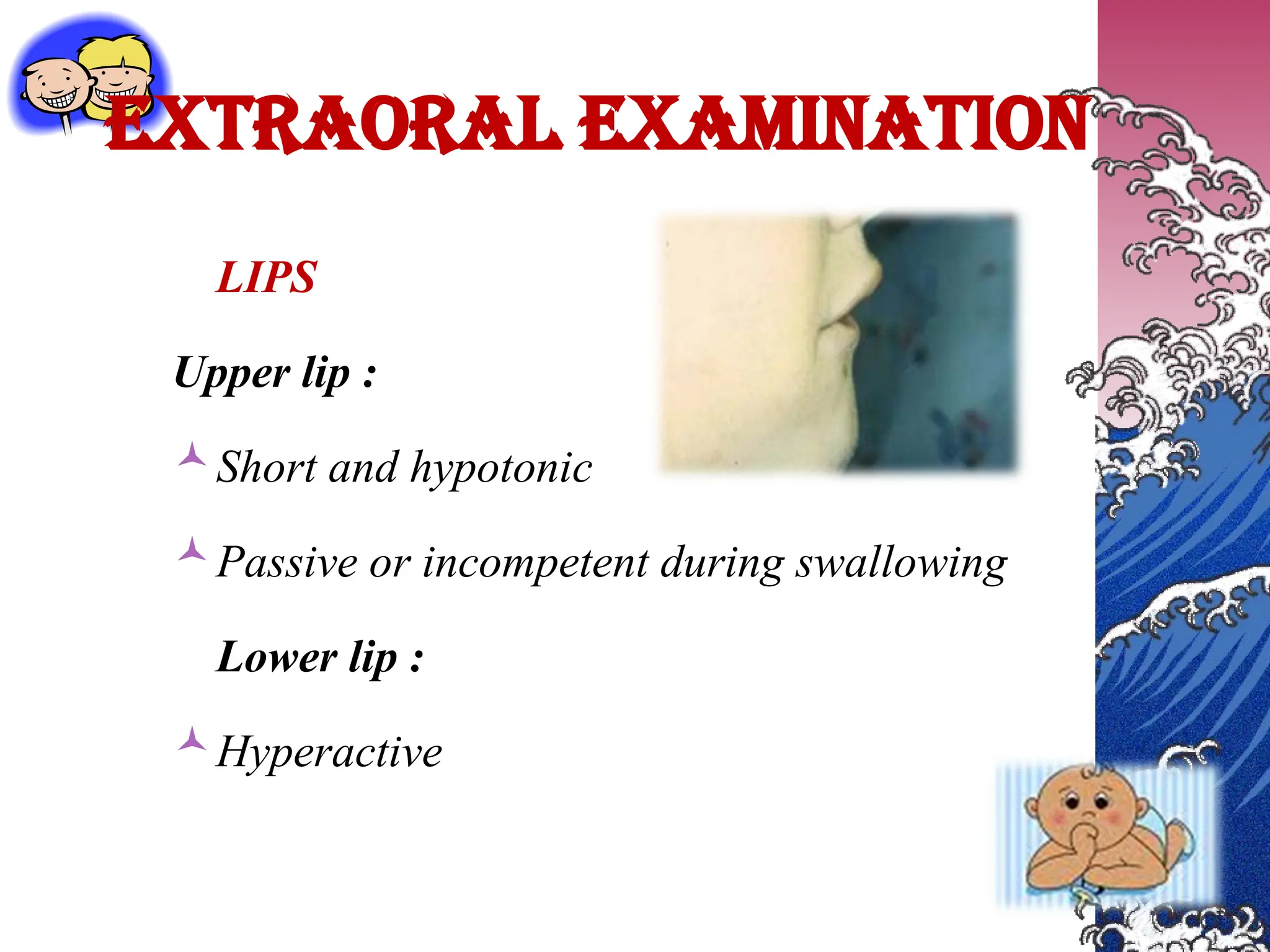 EXTRAORAL EXAMINATION
LIPS
Upper lip :
Short and hypotonic
Passive or incompetent during swallowing
Lower lip :
Hyperactive
 