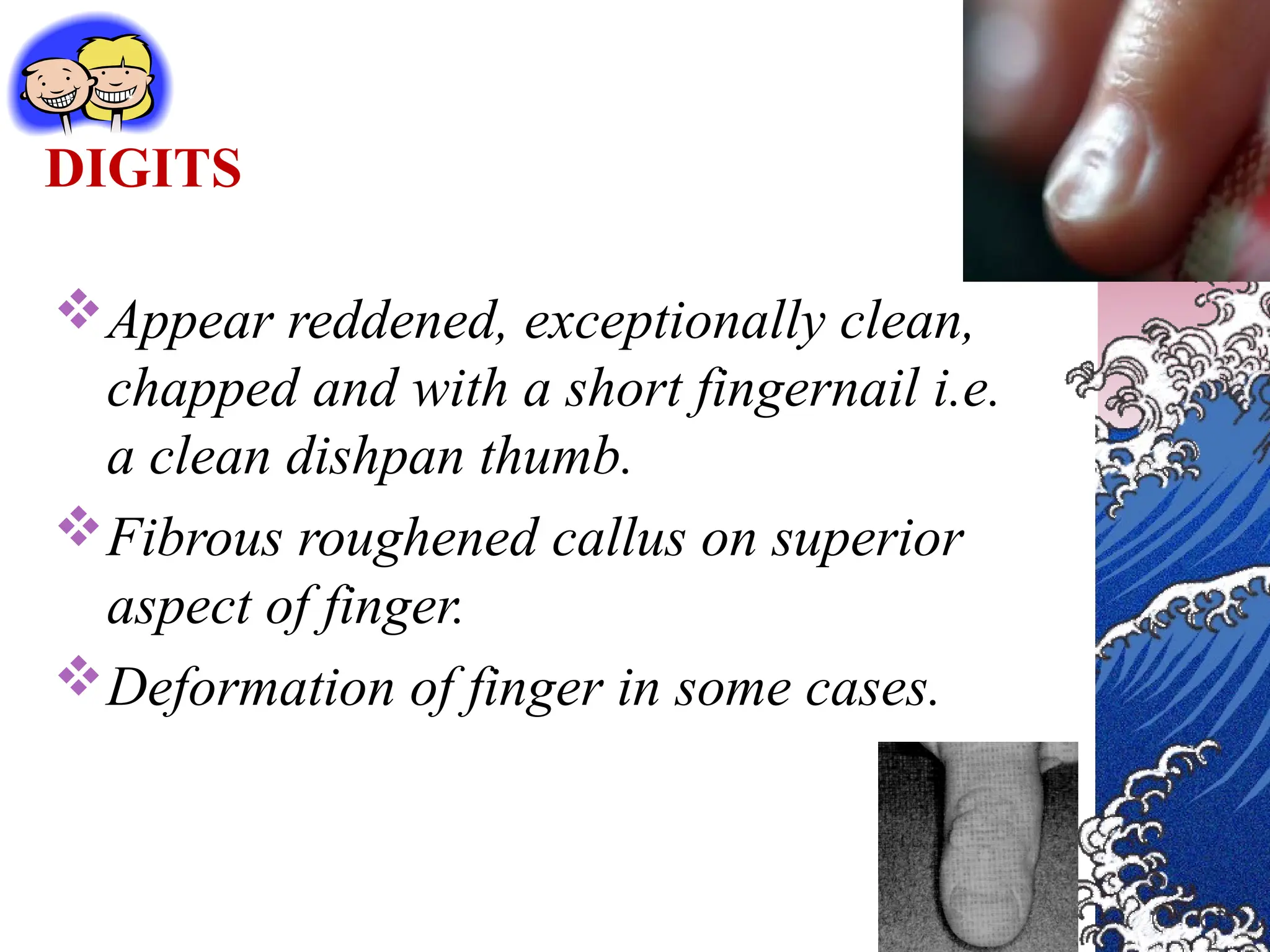DIGITS
Appear reddened, exceptionally clean,
chapped and with a short fingernail i.e.
a clean dishpan thumb.
Fibrous roughened callus on superior
aspect of finger.
Deformation of finger in some cases.
 