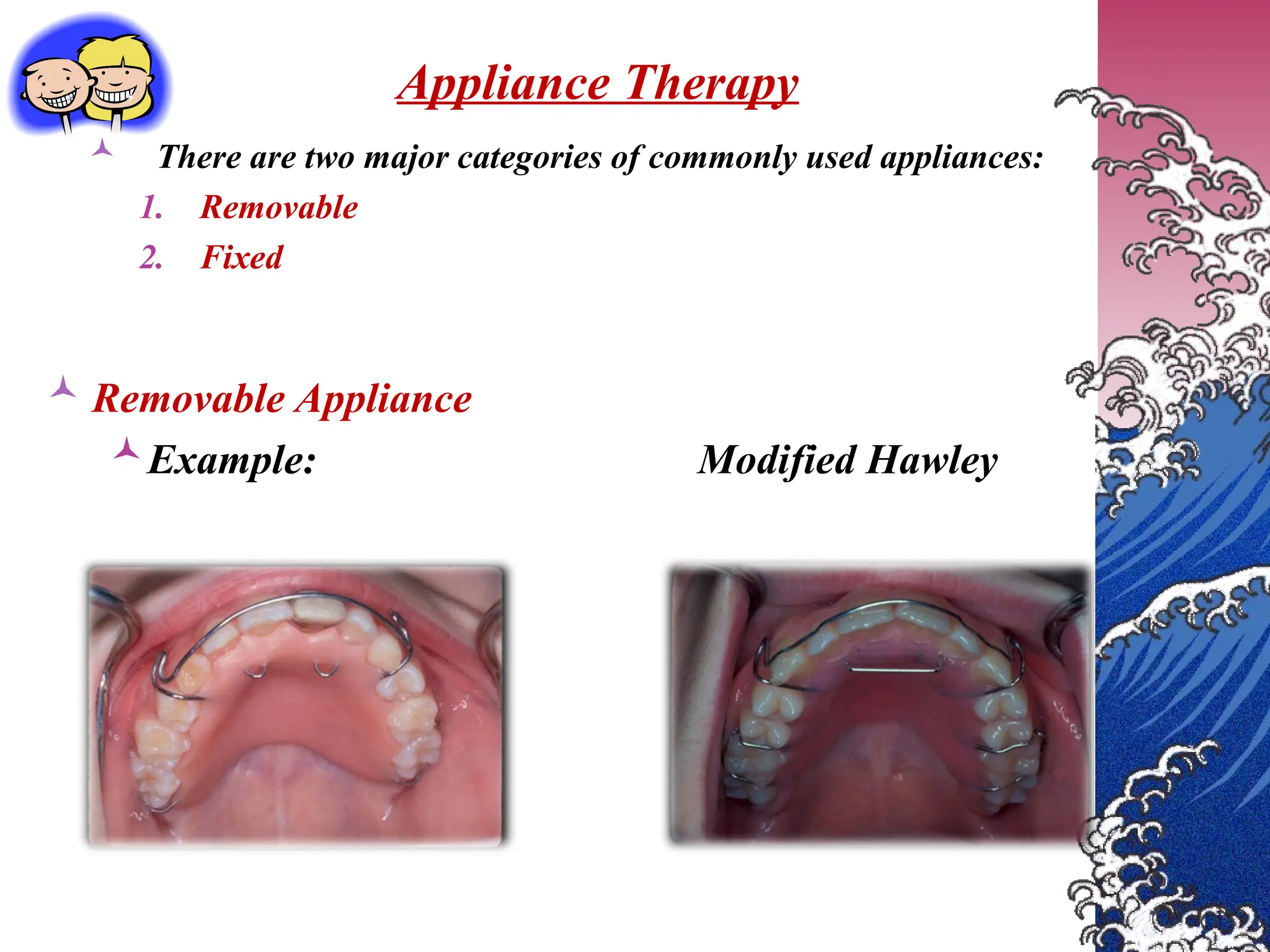  There are two major categories of commonly used appliances:
1. Removable
2. Fixed
Appliance Therapy
 Removable Appliance
Example: Modified Hawley
 