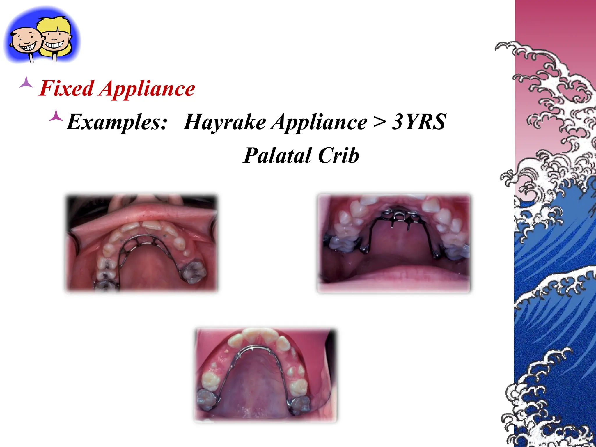 Fixed Appliance
Examples: Hayrake Appliance > 3YRS
Palatal Crib
 