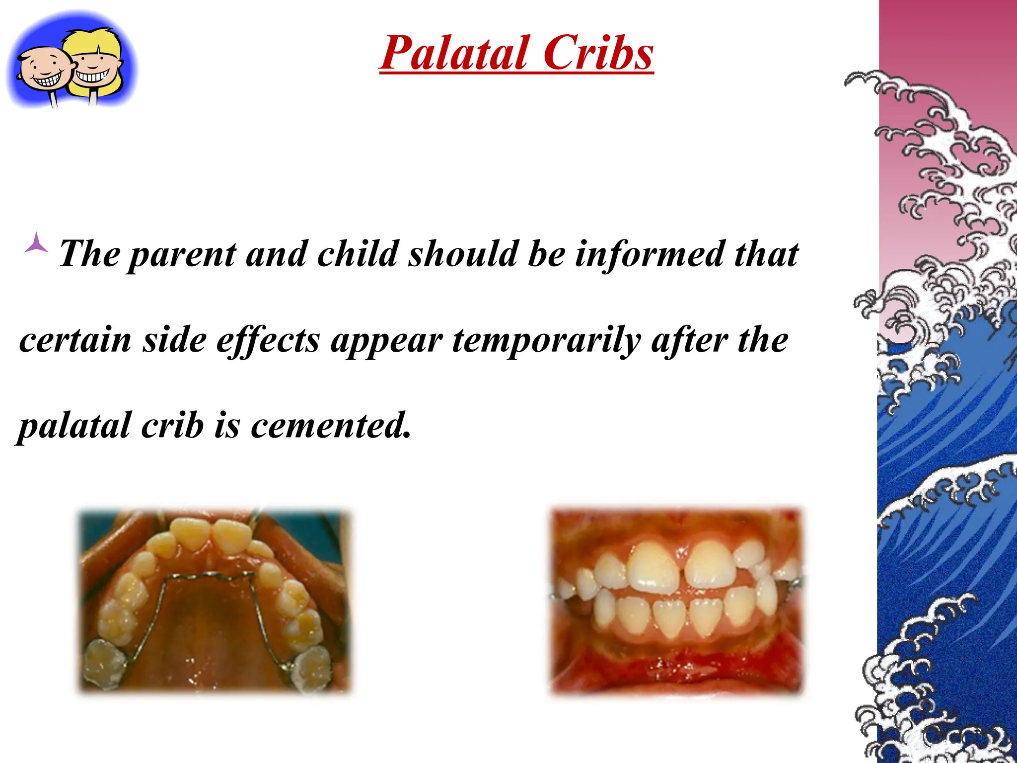 The parent and child should be informed that
certain side effects appear temporarily after the
palatal crib is cemented.
Palatal Cribs
 