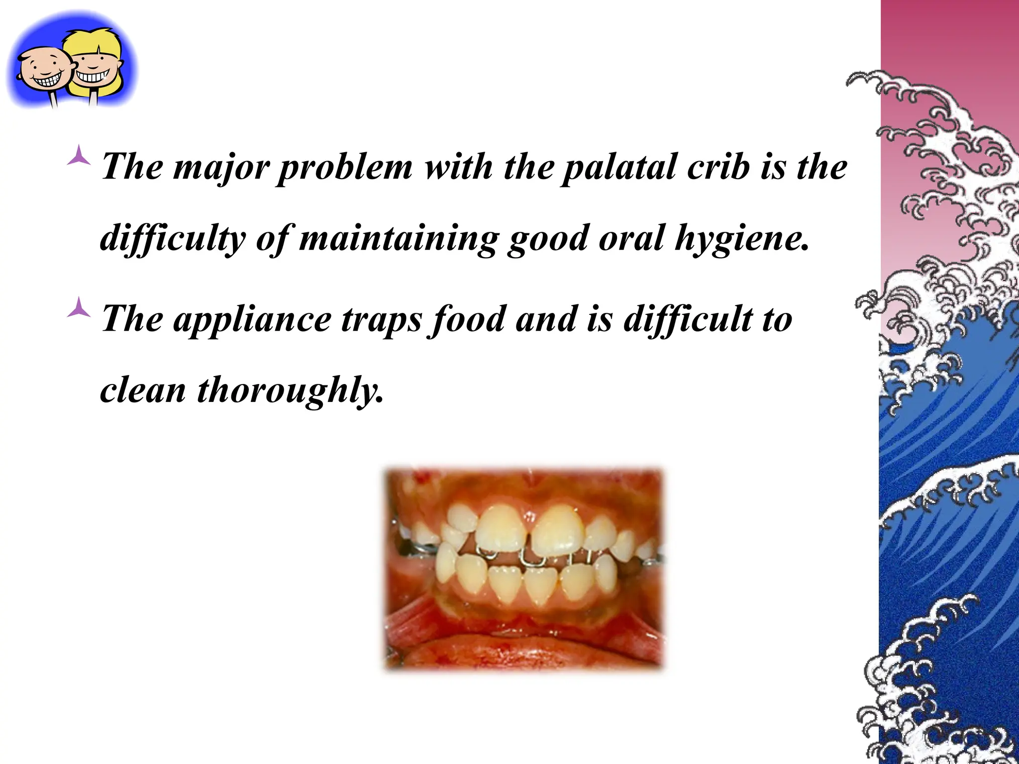 The major problem with the palatal crib is the
difficulty of maintaining good oral hygiene.
The appliance traps food and is difficult to
clean thoroughly.
 