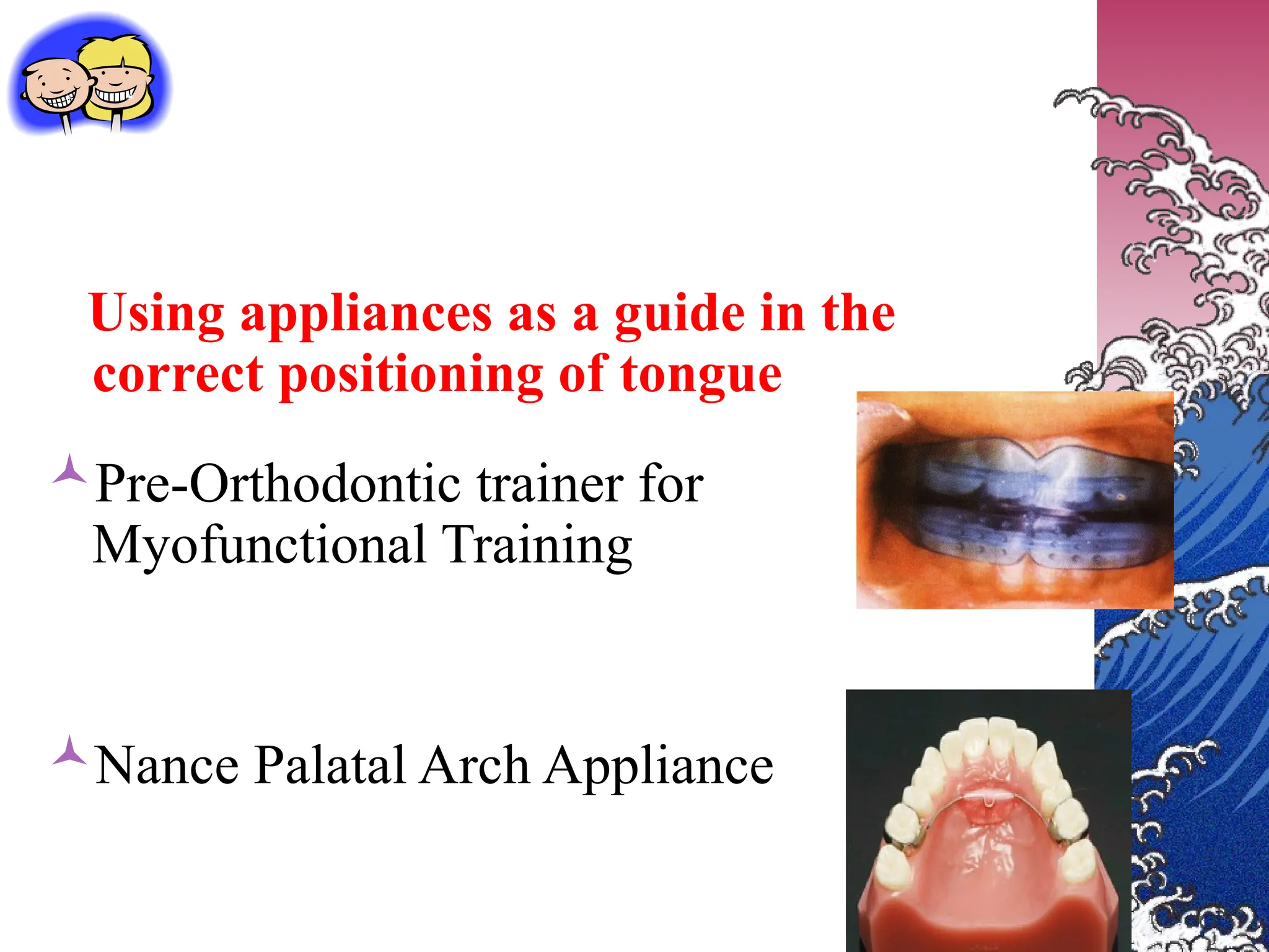 Using appliances as a guide in the
correct positioning of tongue
Pre-Orthodontic trainer for
Myofunctional Training
Nance Palatal Arch Appliance
 