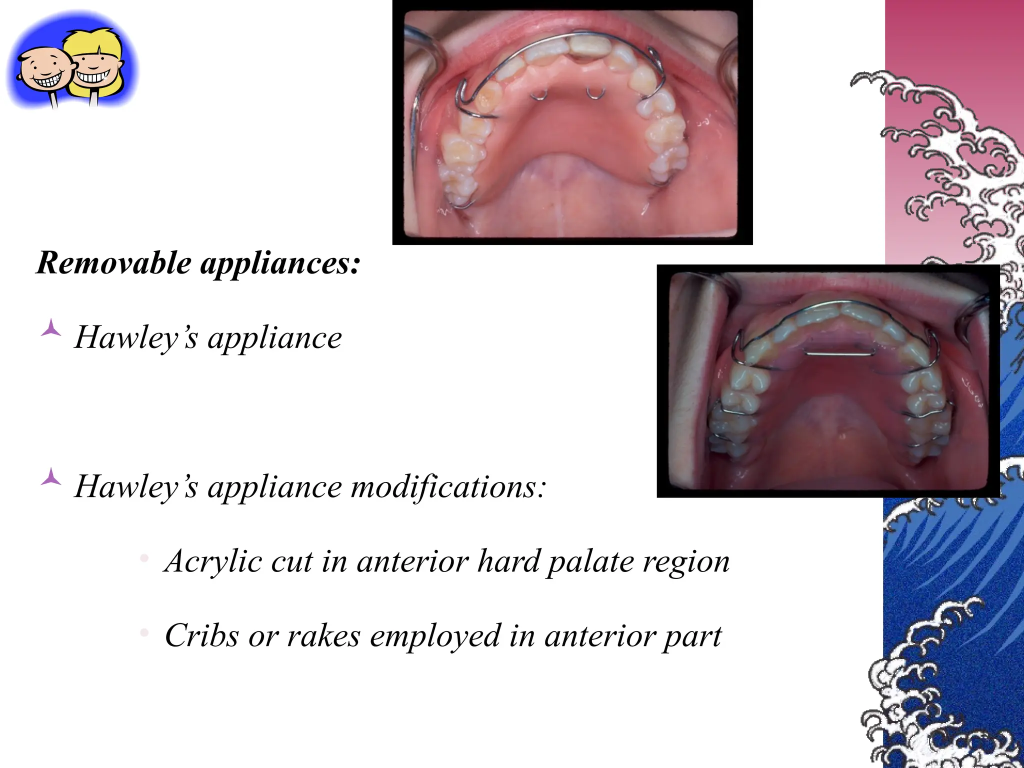 Removable appliances:
 Hawley’s appliance
 Hawley’s appliance modifications:
• Acrylic cut in anterior hard palate region
• Cribs or rakes employed in anterior part
 