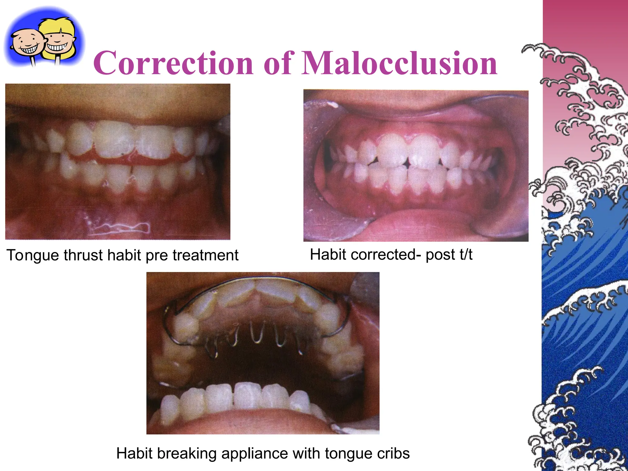 Correction of Malocclusion
Tongue thrust habit pre treatment Habit corrected- post t/t
Habit breaking appliance with tongue cribs
 