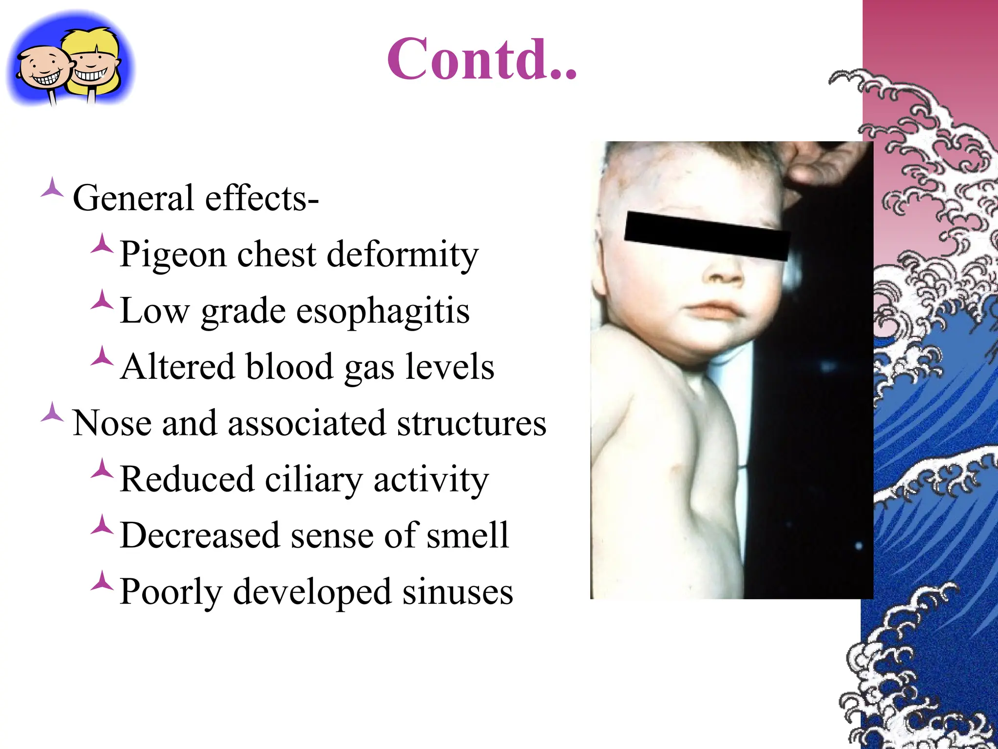 Contd..
General effects-
Pigeon chest deformity
Low grade esophagitis
Altered blood gas levels
Nose and associated structures
Reduced ciliary activity
Decreased sense of smell
Poorly developed sinuses
 