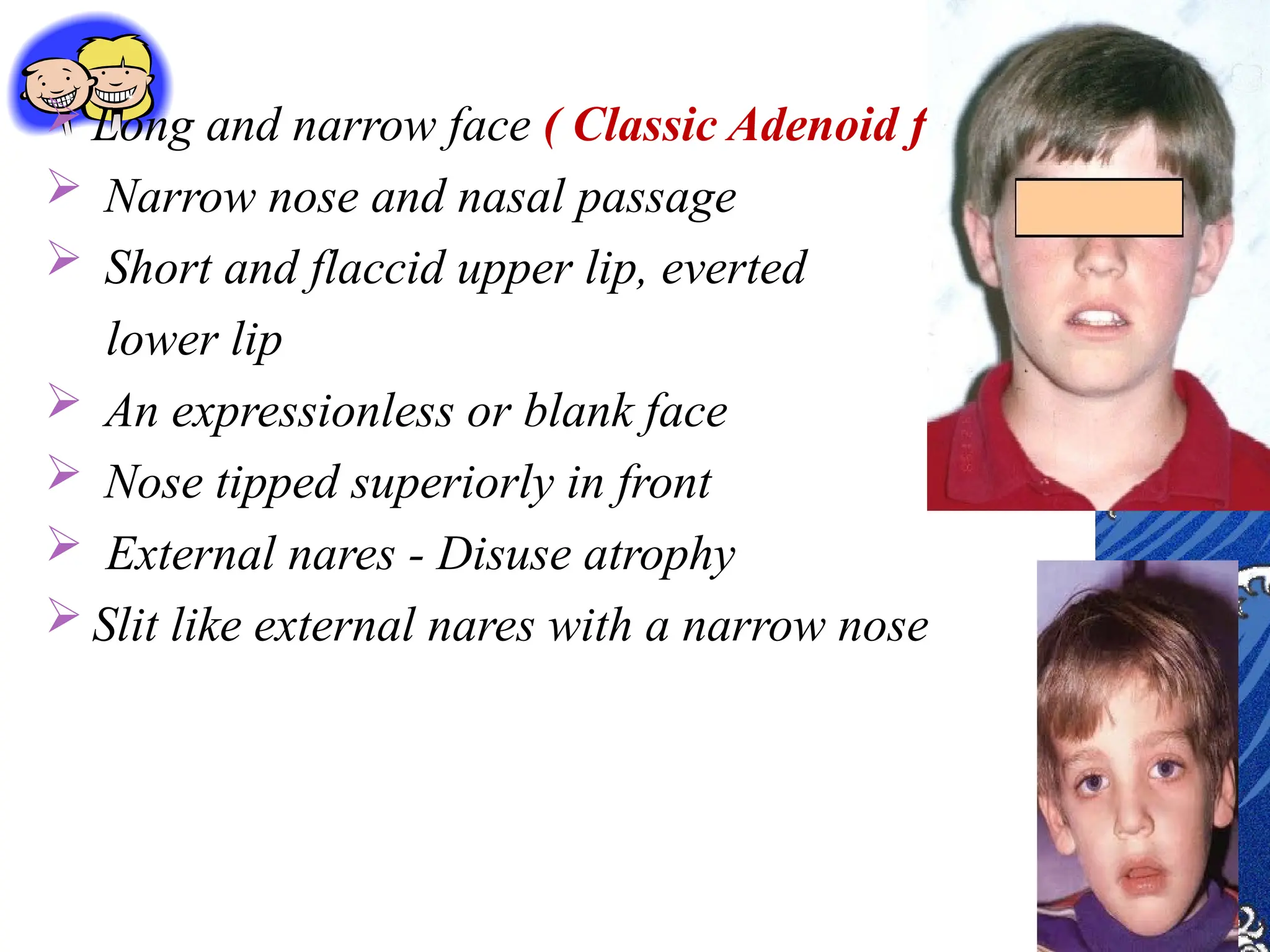  Long and narrow face ( Classic Adenoid facies)
 Narrow nose and nasal passage
 Short and flaccid upper lip, everted
lower lip
 An expressionless or blank face
 Nose tipped superiorly in front
 External nares - Disuse atrophy
 Slit like external nares with a narrow nose
 