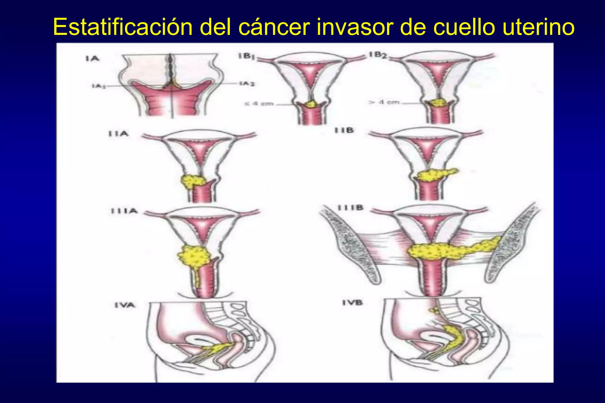 Estatificación del cáncer invasor de cuello uterino
 