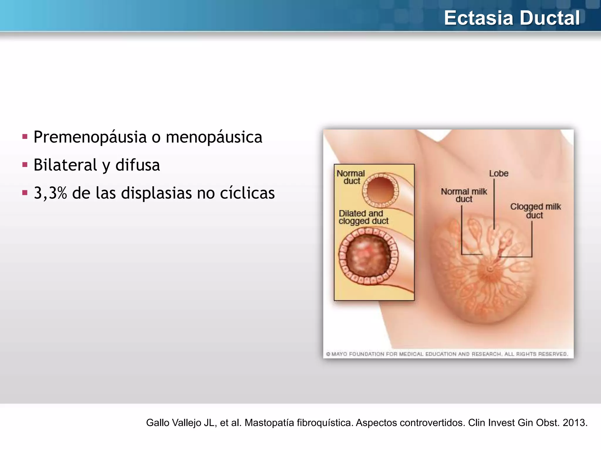 Ectasia Ductal

 Premenopáusia o menopáusica
 Bilateral y difusa

 3,3% de las displasias no cíclicas

Gallo Vallejo JL, et al. Mastopatía fibroquística. Aspectos controvertidos. Clin Invest Gin Obst. 2013.

 