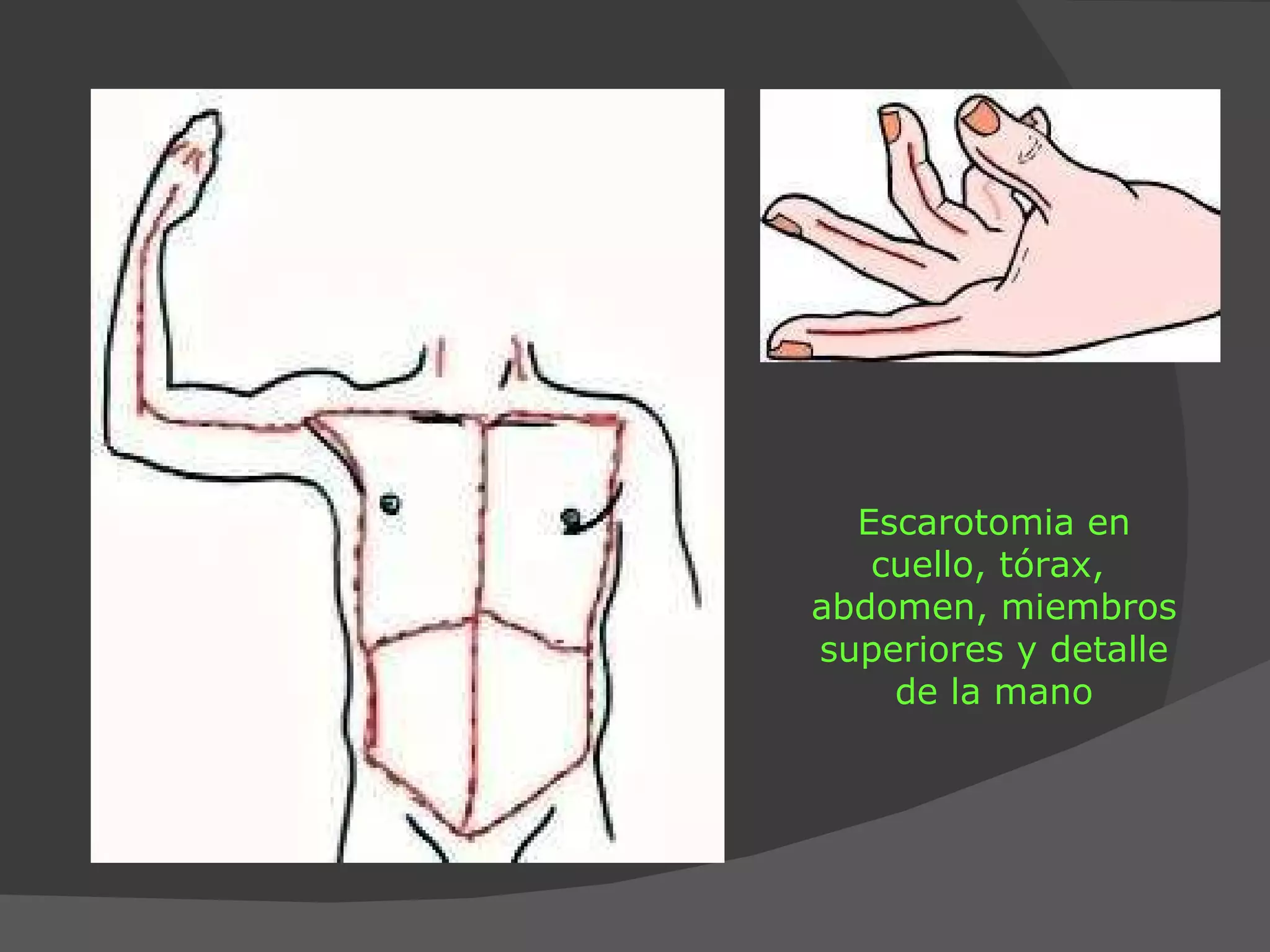 Escarotomia en cuello, tórax,  abdomen, miembros superiores y detalle de la mano 