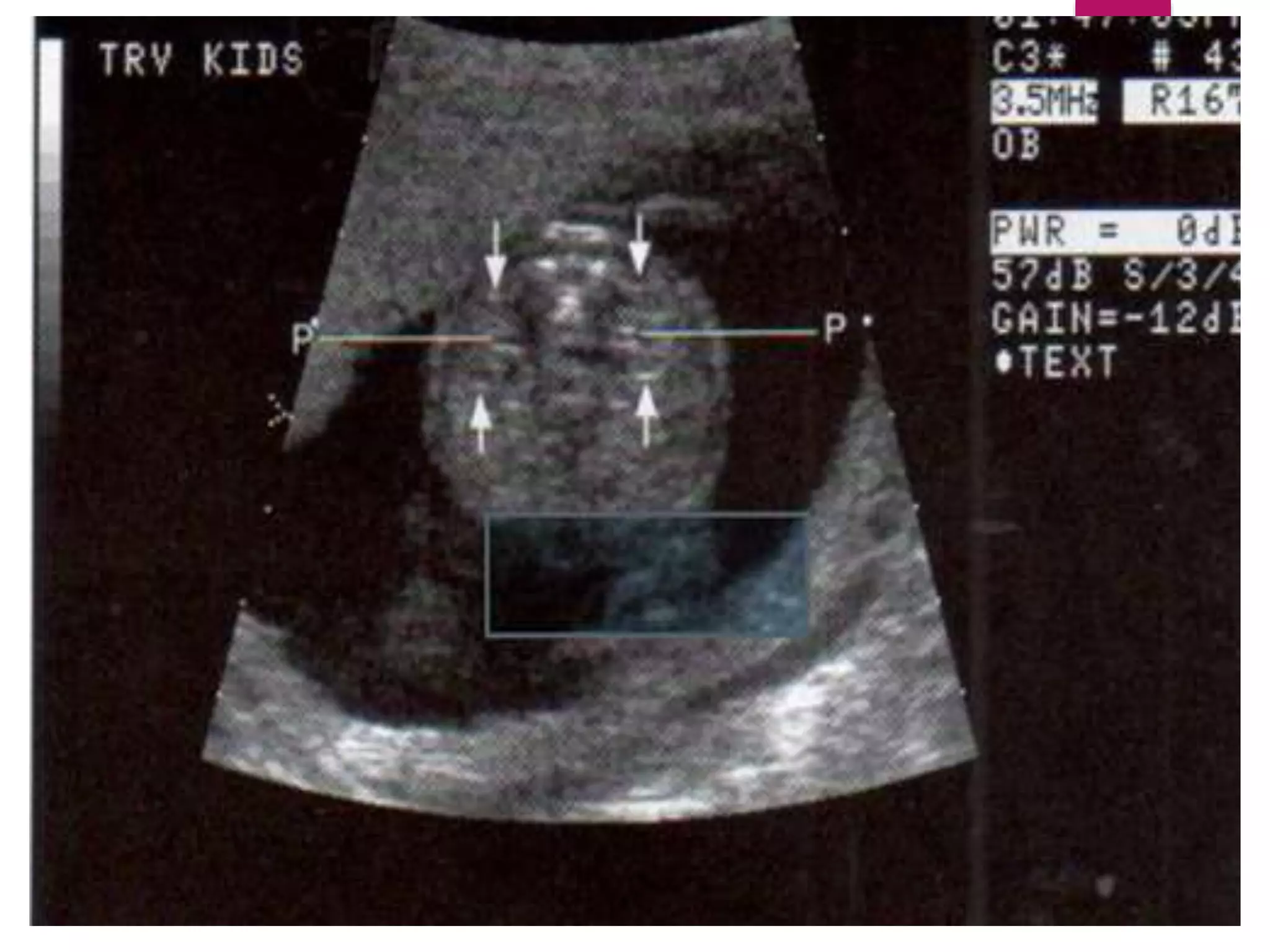 EL SISTEMA GENITOURINARIO FETAL
 