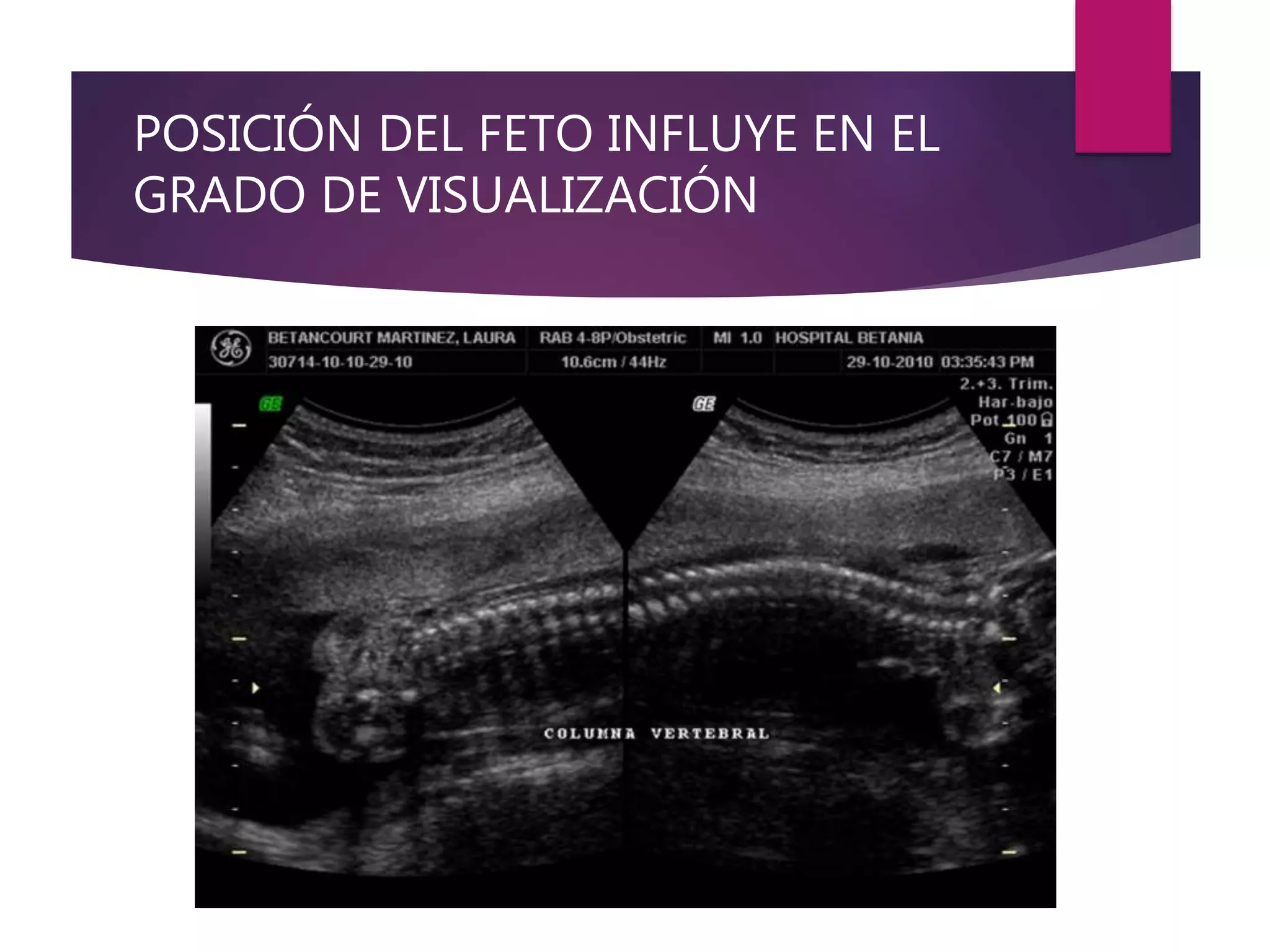 POSICIÓN DEL FETO INFLUYE EN EL
GRADO DE VISUALIZACIÓN
 