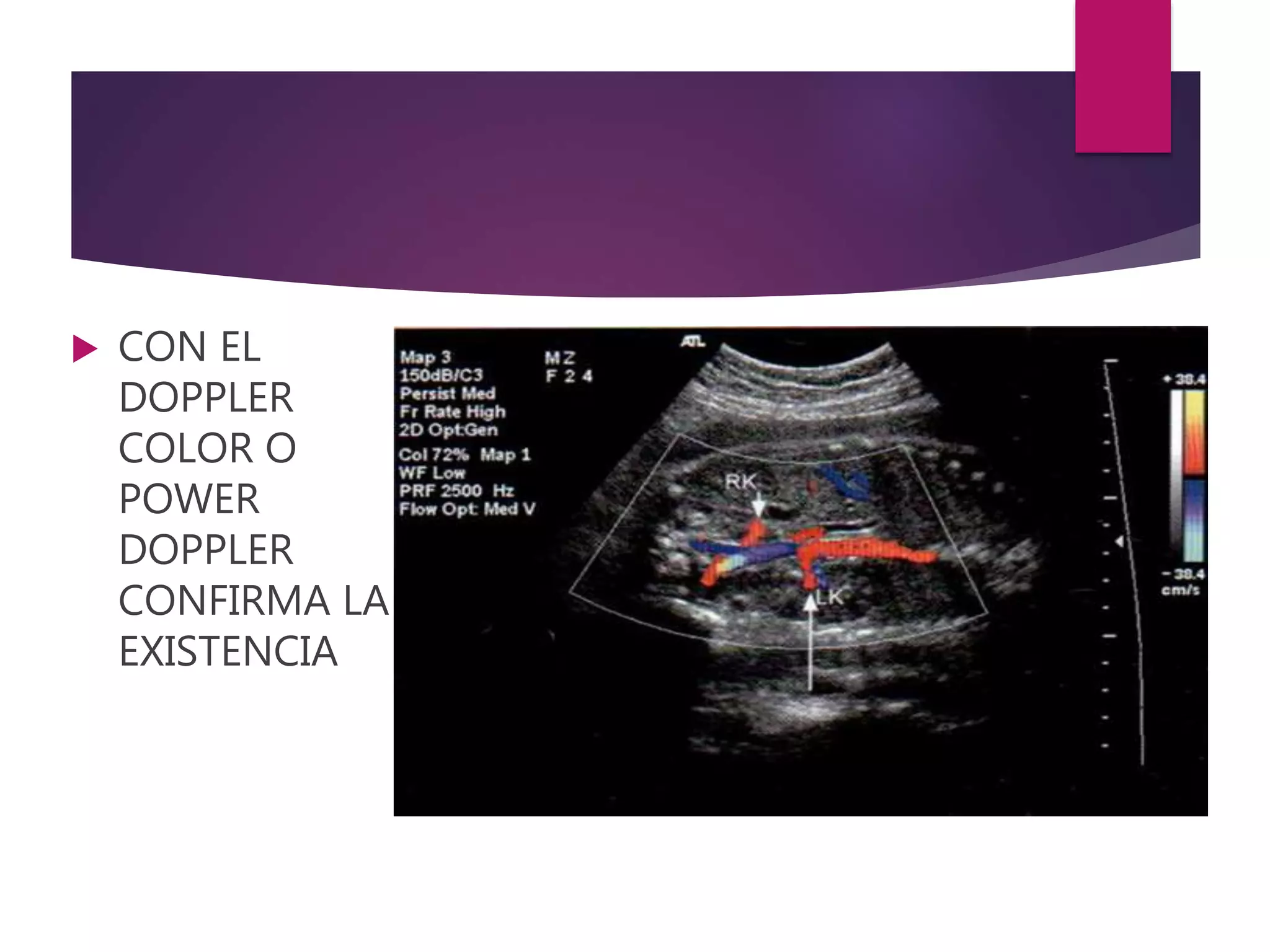  CON EL
DOPPLER
COLOR O
POWER
DOPPLER
CONFIRMA LA
EXISTENCIA
 